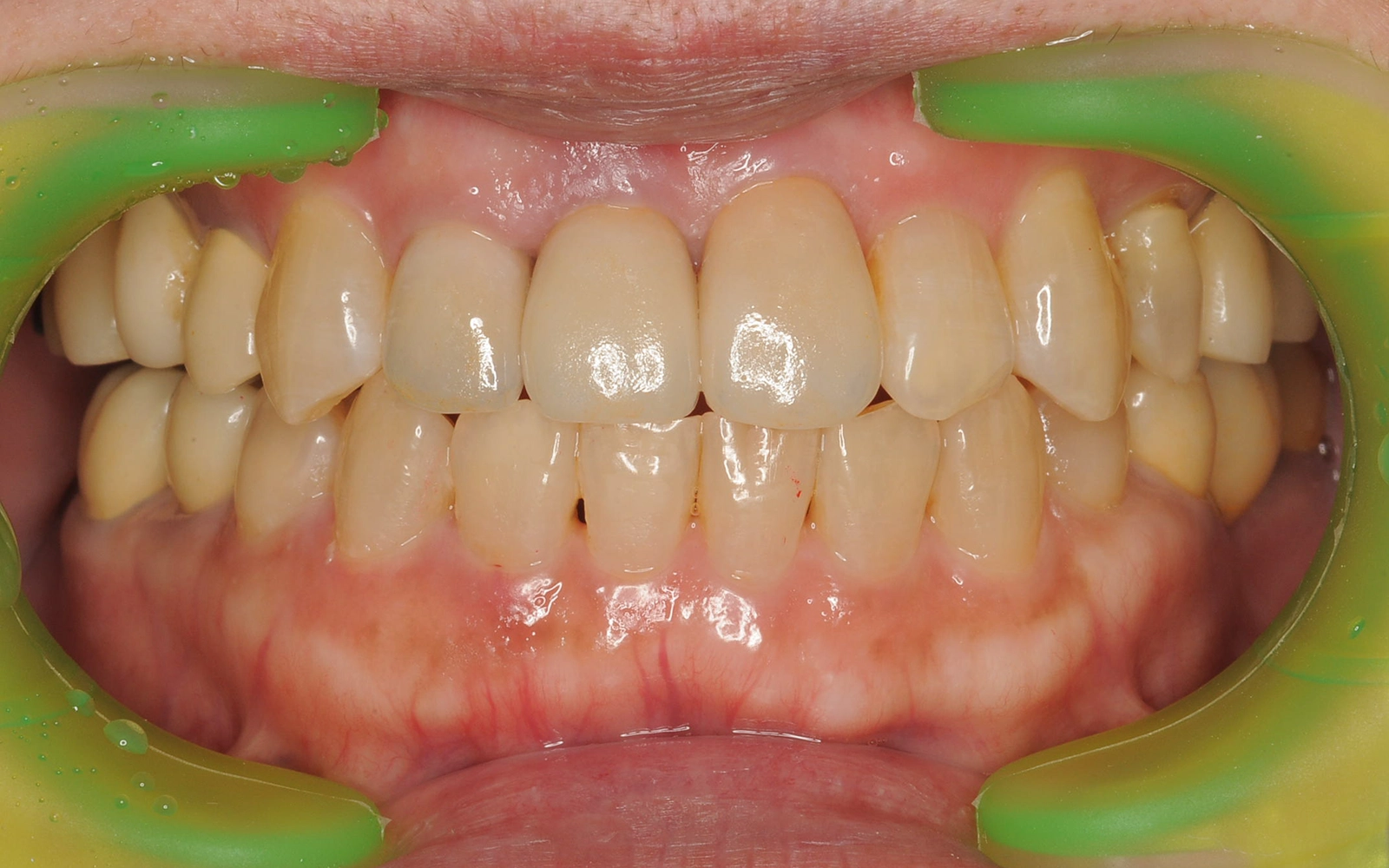 前歯をきれいにしたいの治療後