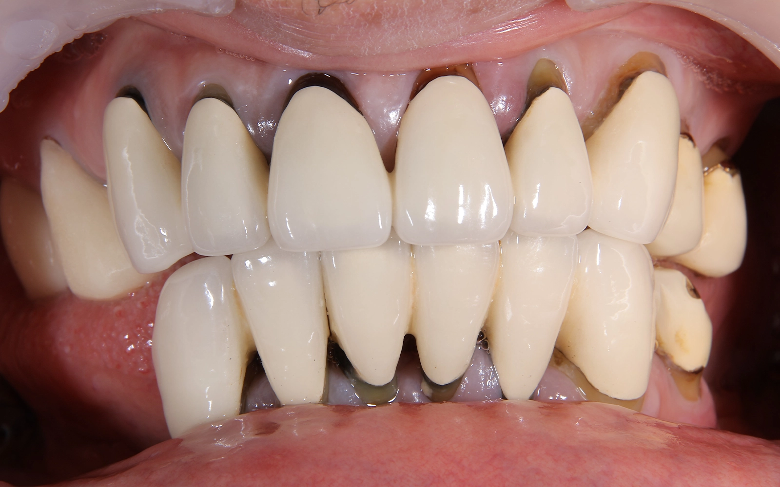 全体的に噛めないの治療前