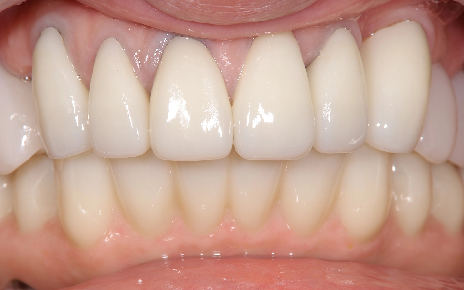 全体的に噛めないの治療後