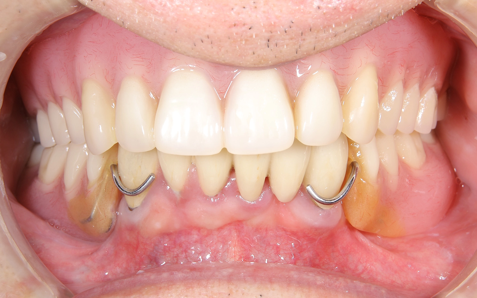 入れ歯が使えないの治療前