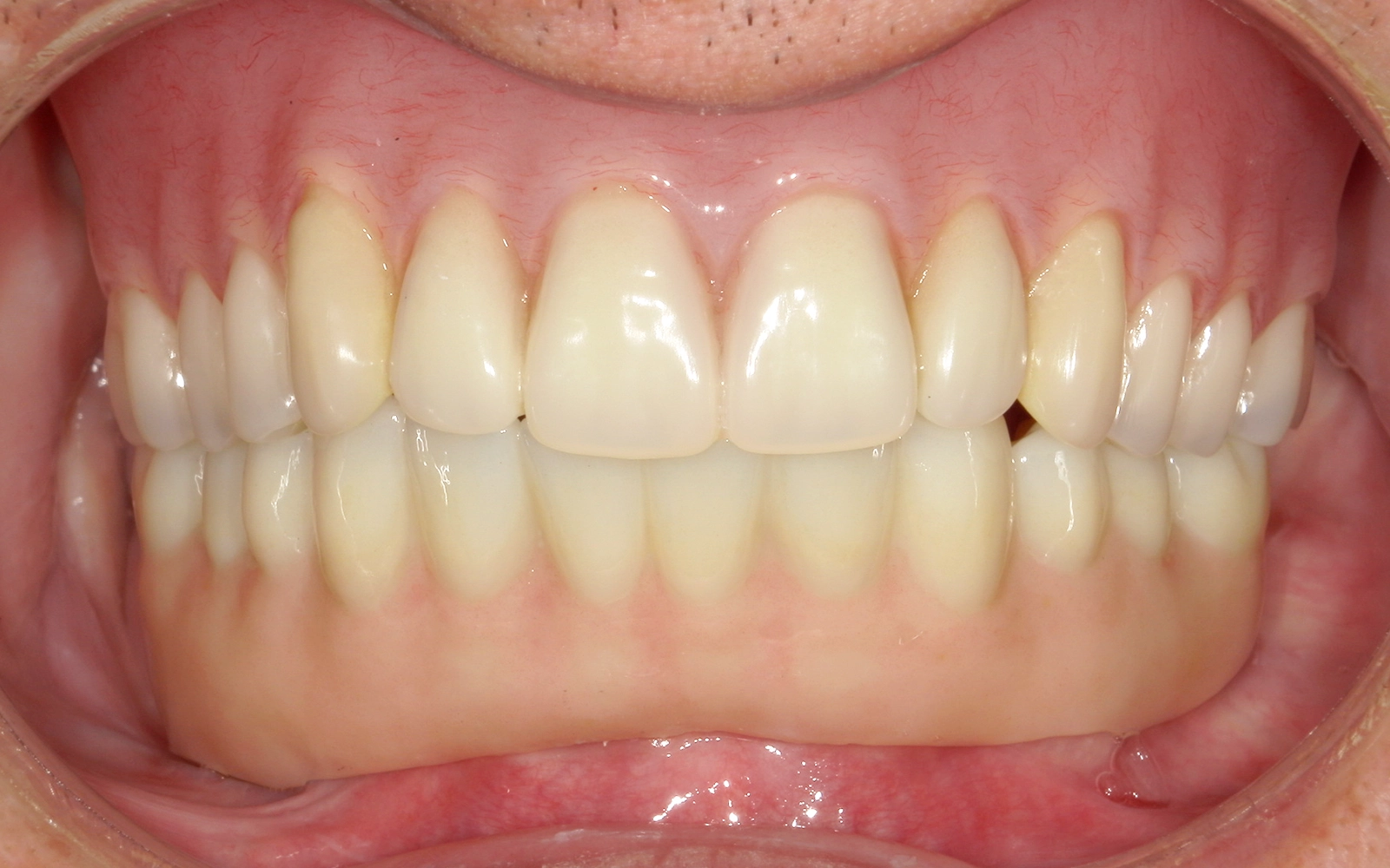 入れ歯が使えないの治療後