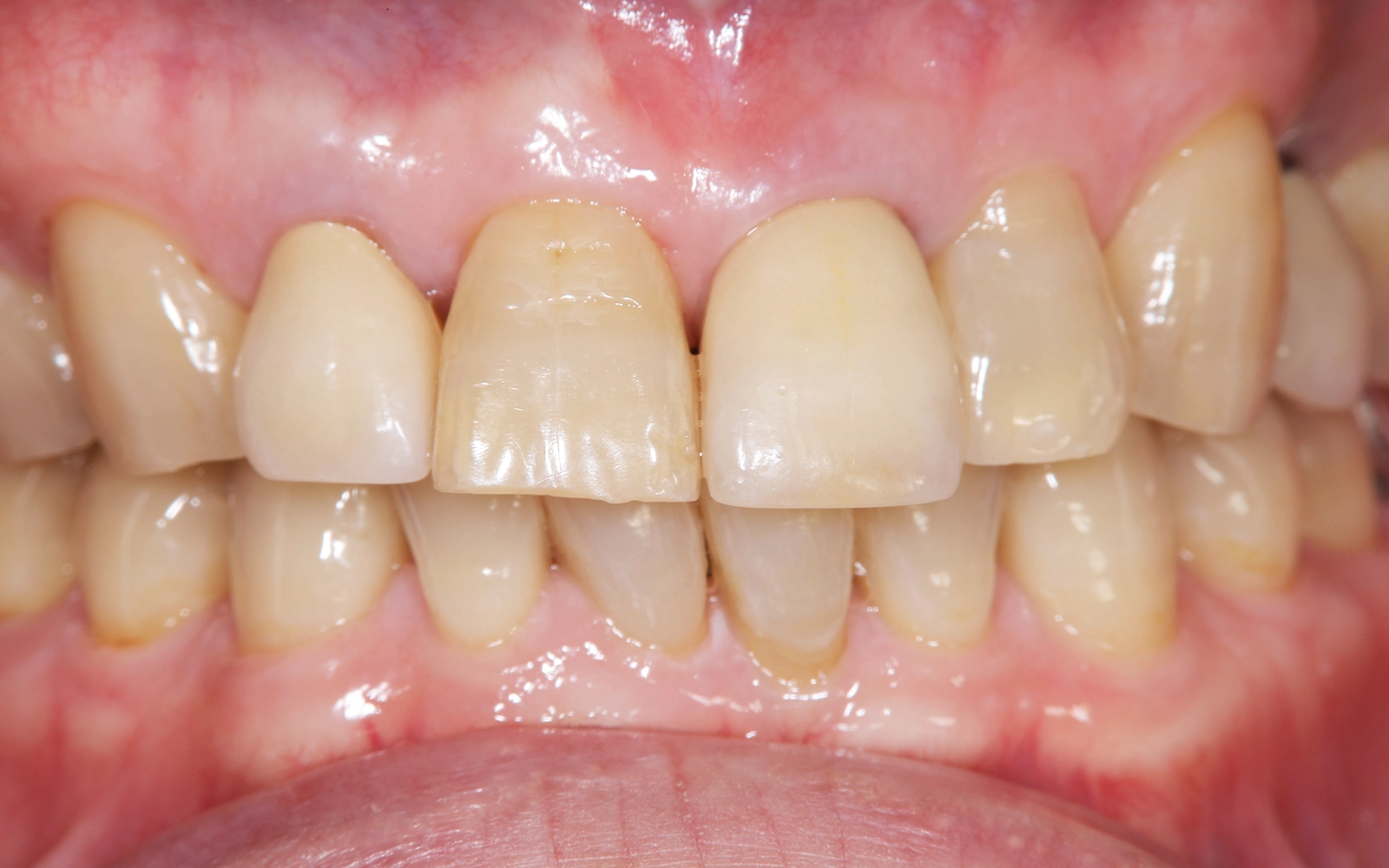 前歯をやりなおしたいの治療前