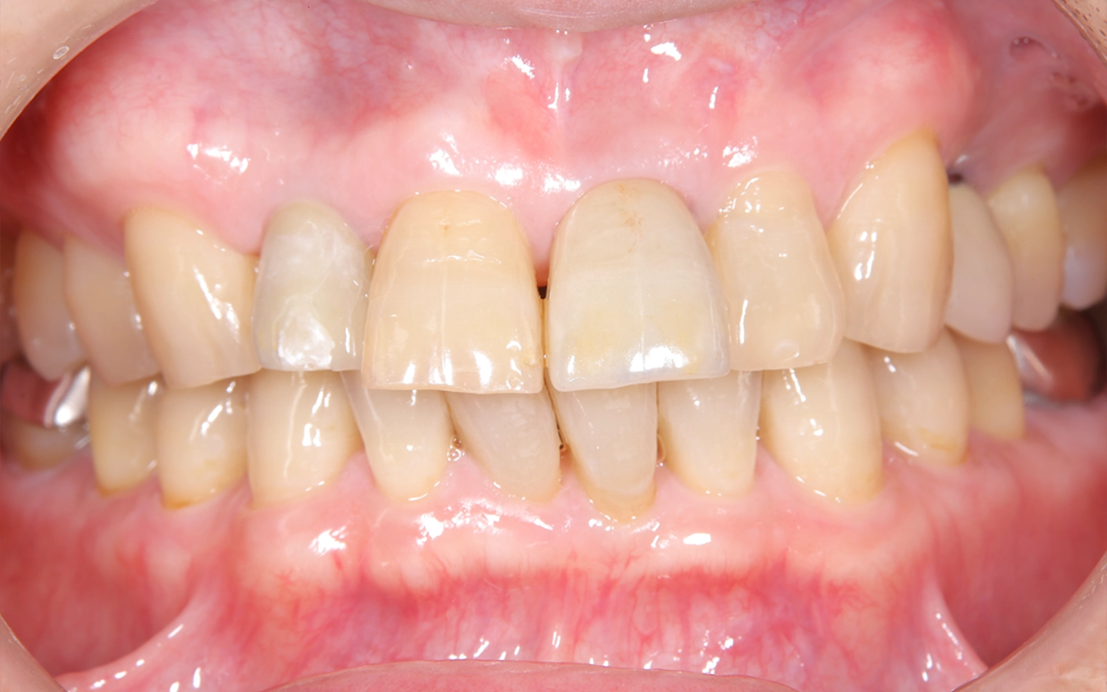 前歯をやりなおしたいの治療後