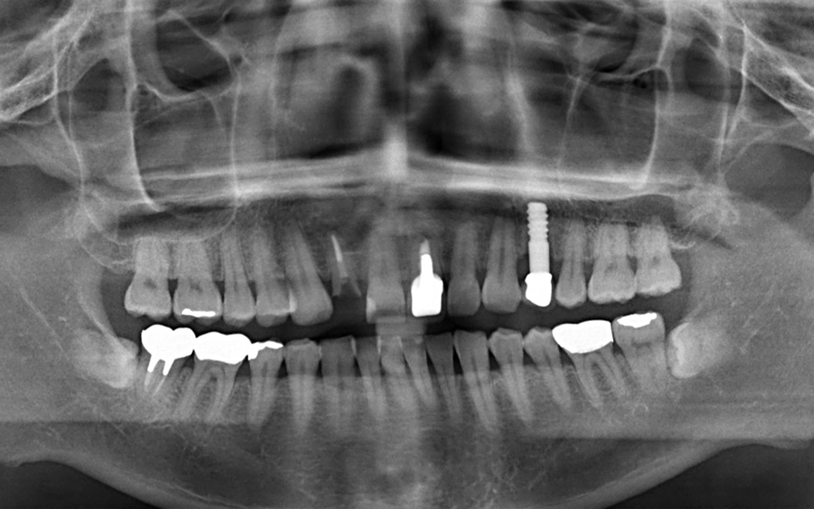 初診時におけるレントゲン写真