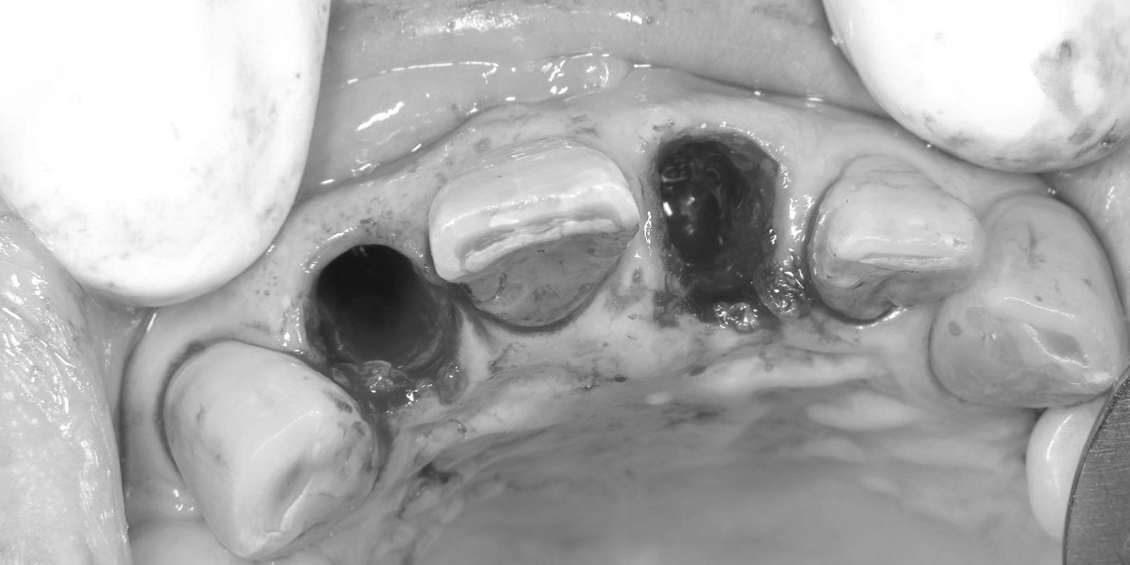 抜歯（右上2番・左上1番）