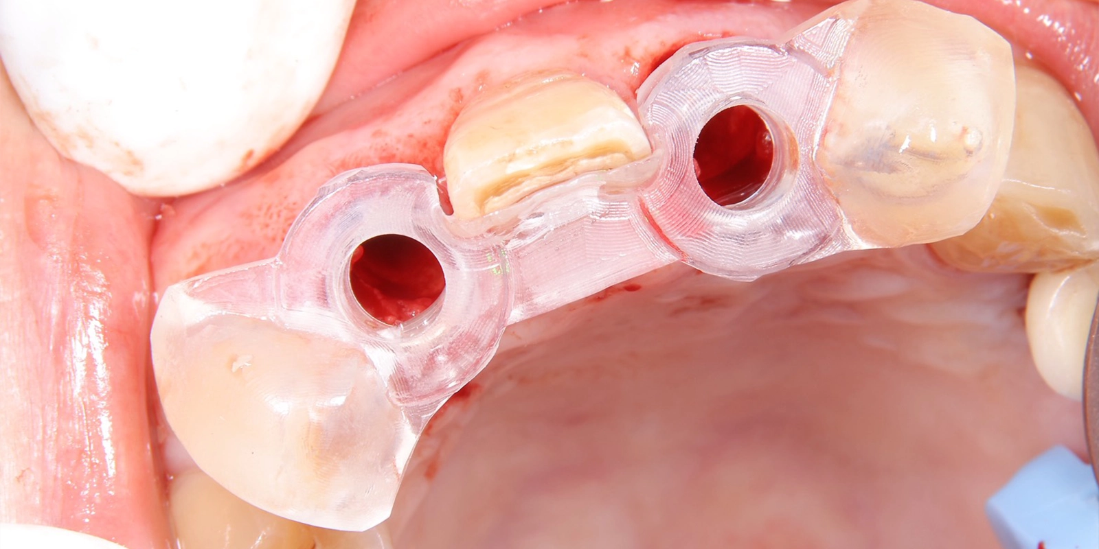 サージカルガイドの装着