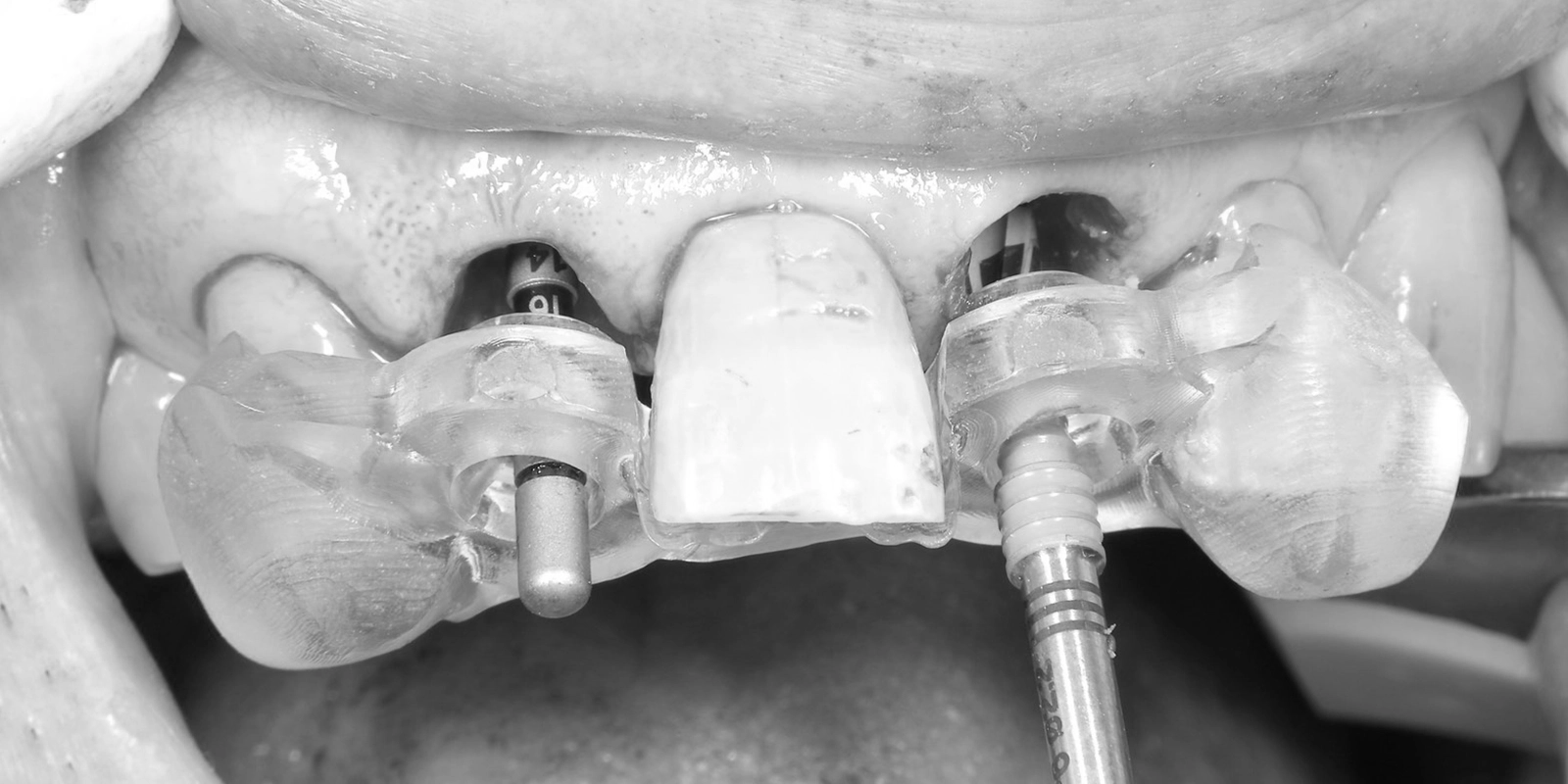 インプラントの埋入