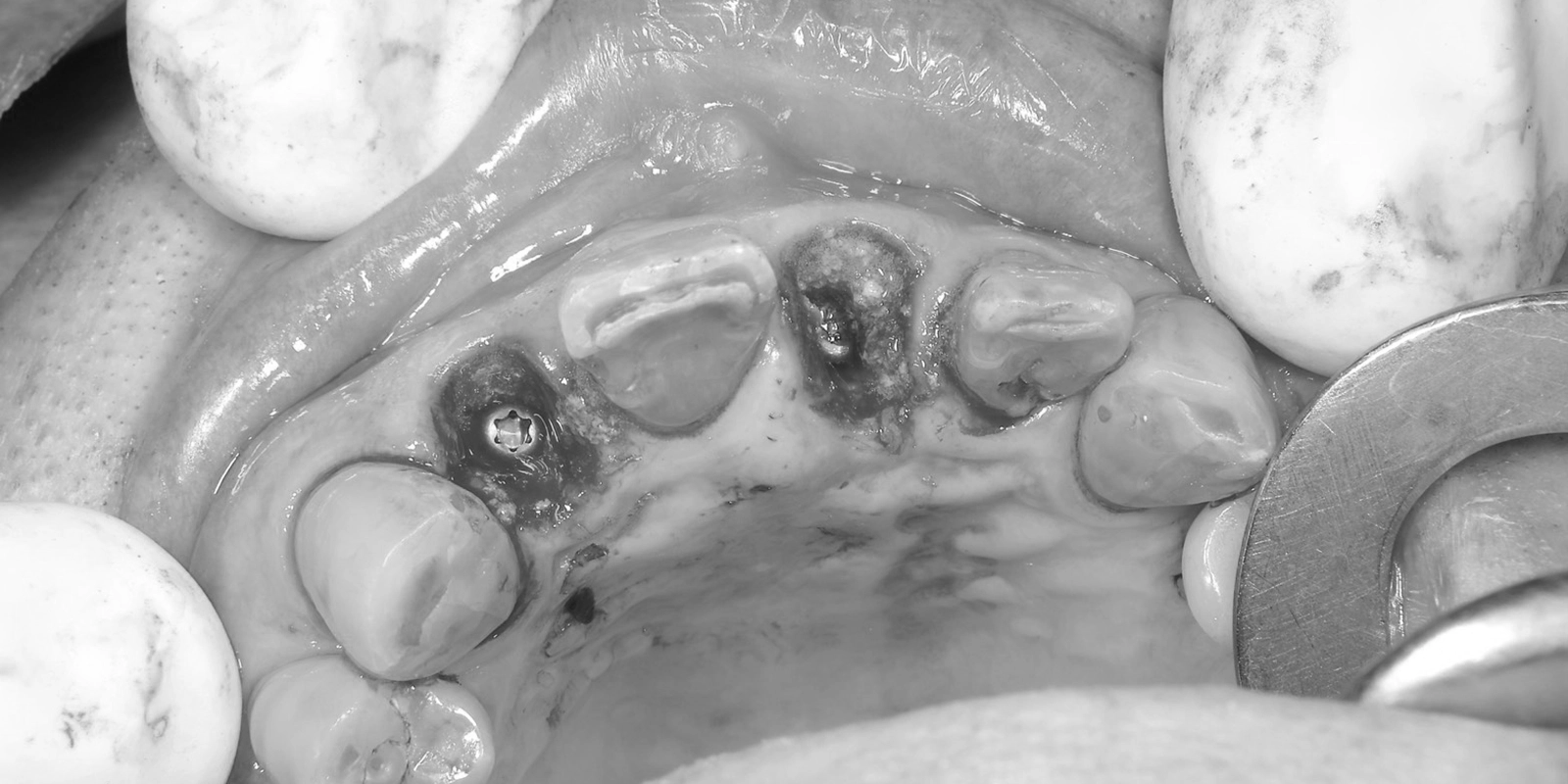 GBR（骨の再生を促す処置）の同時施行