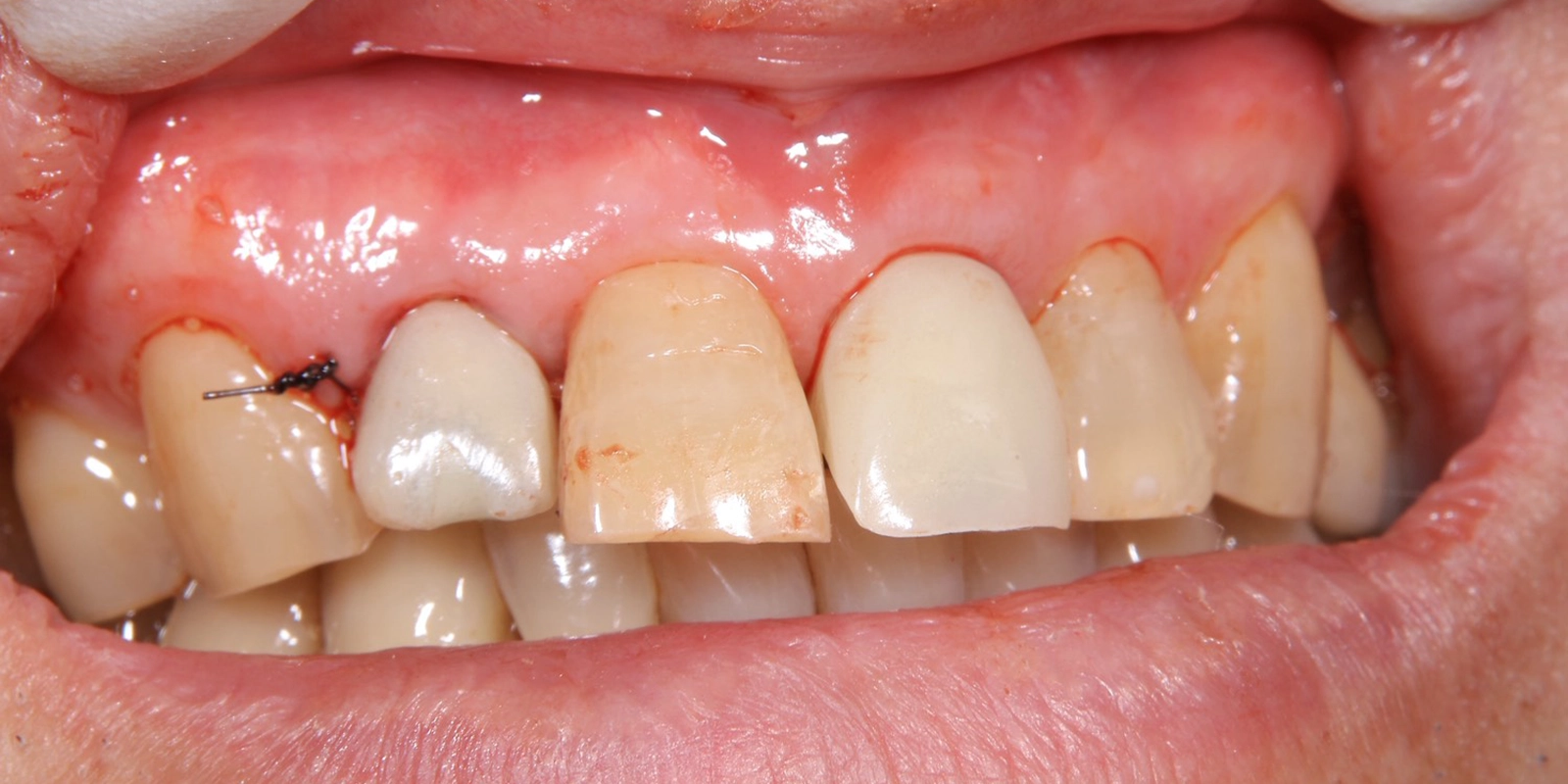 仮歯の装着（同日）