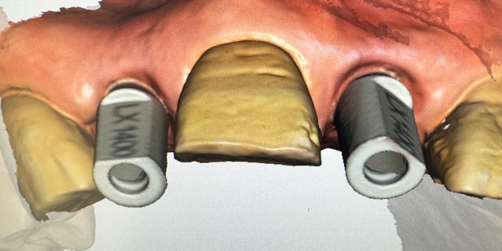 最終的な被せ物（クラウン）の装着