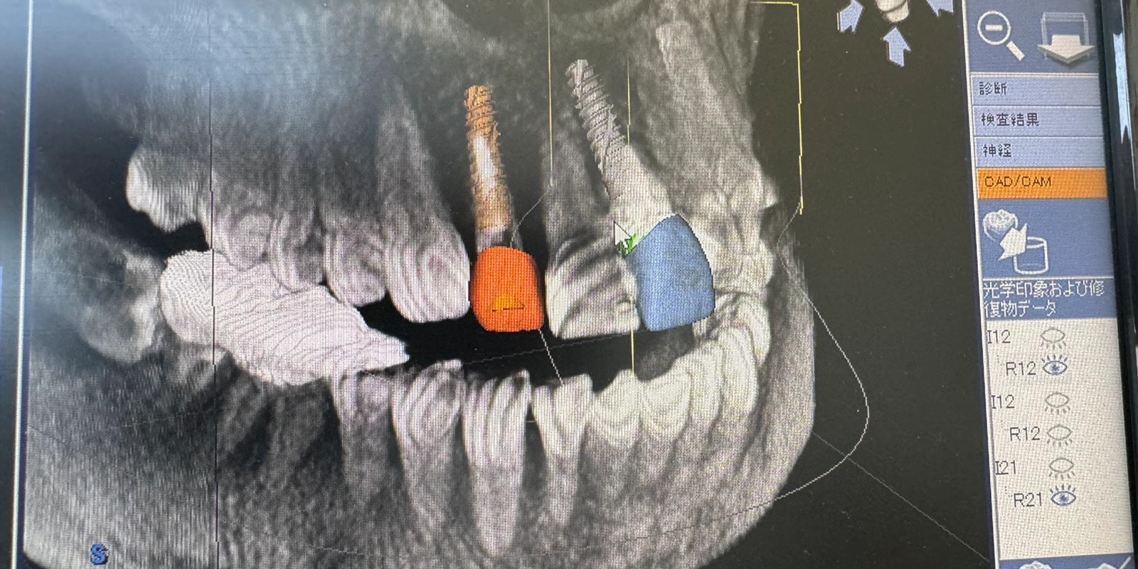 精密検査と治療計画の立案