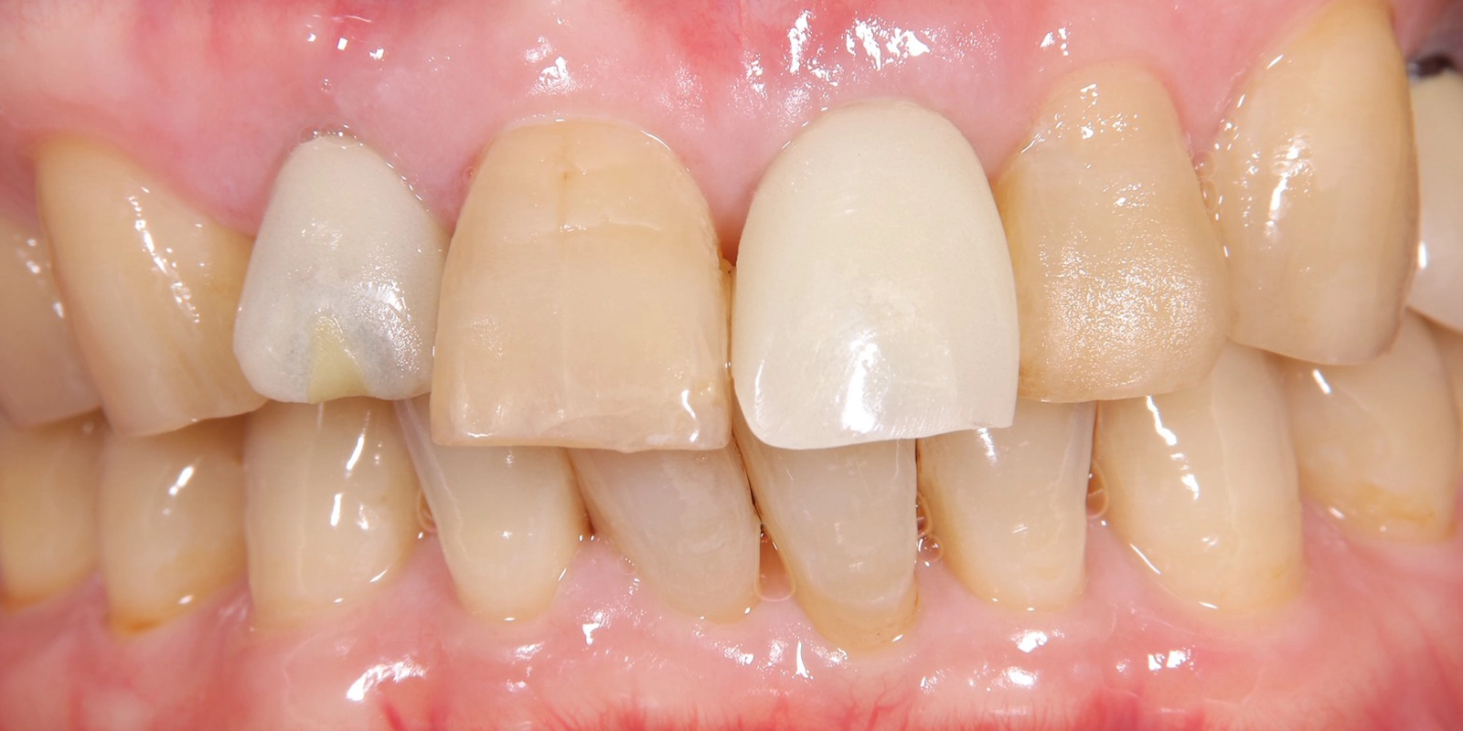 骨との結合を待つ期間