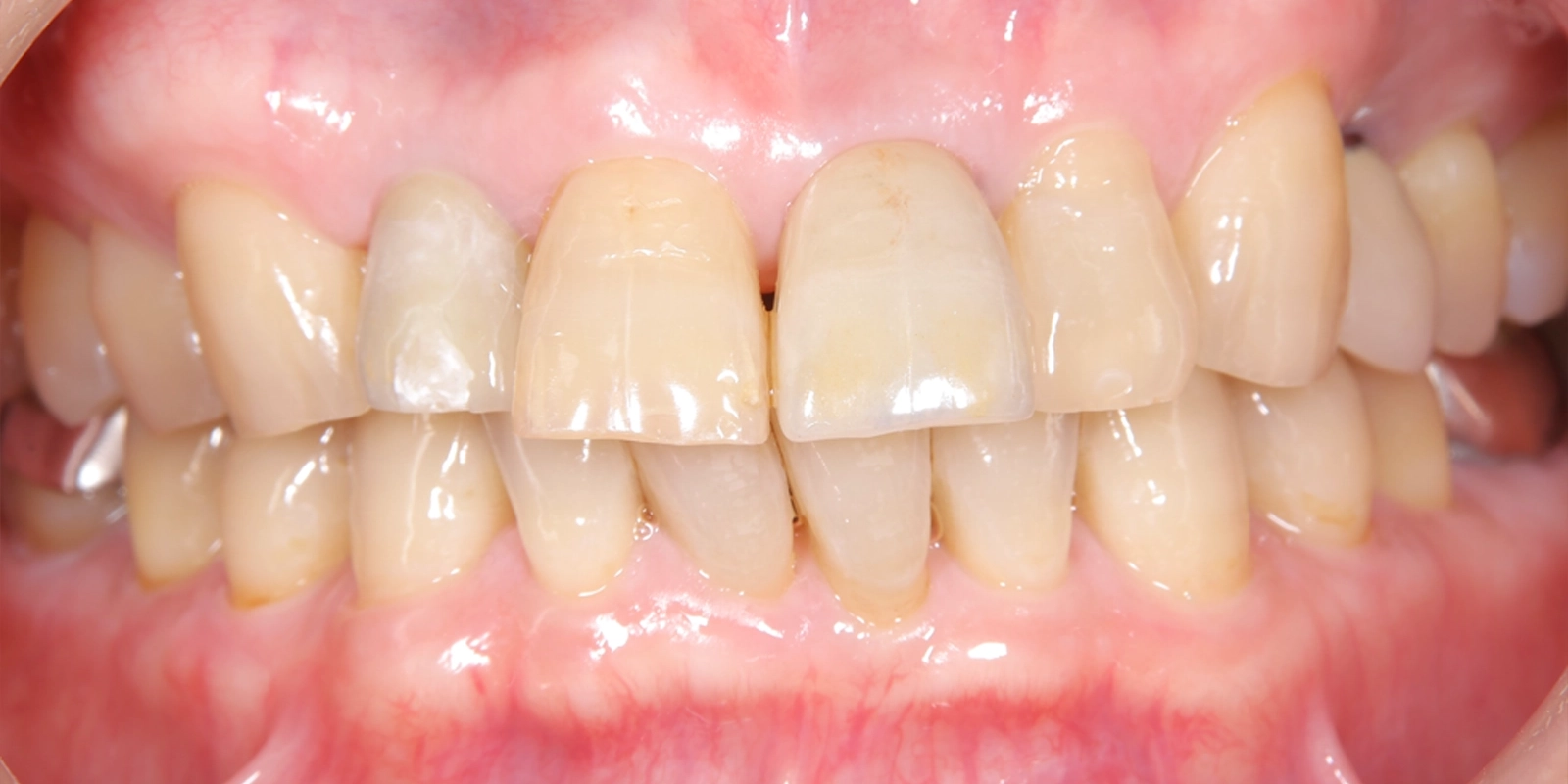 最終的な被せ物（クラウン）の装着