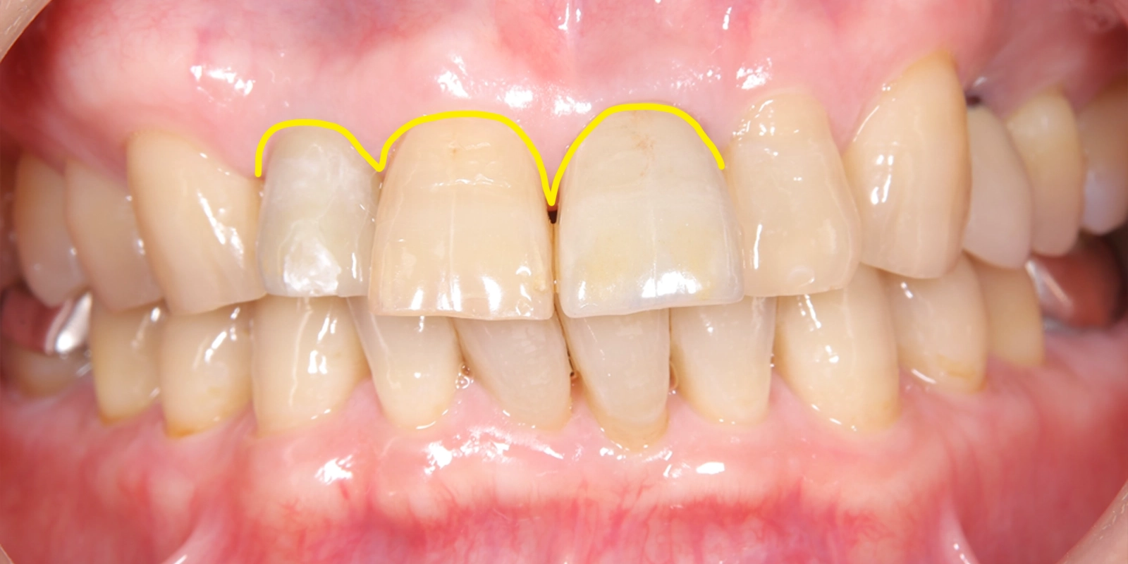 歯肉ラインの形態調整（スキャロップの整え方）