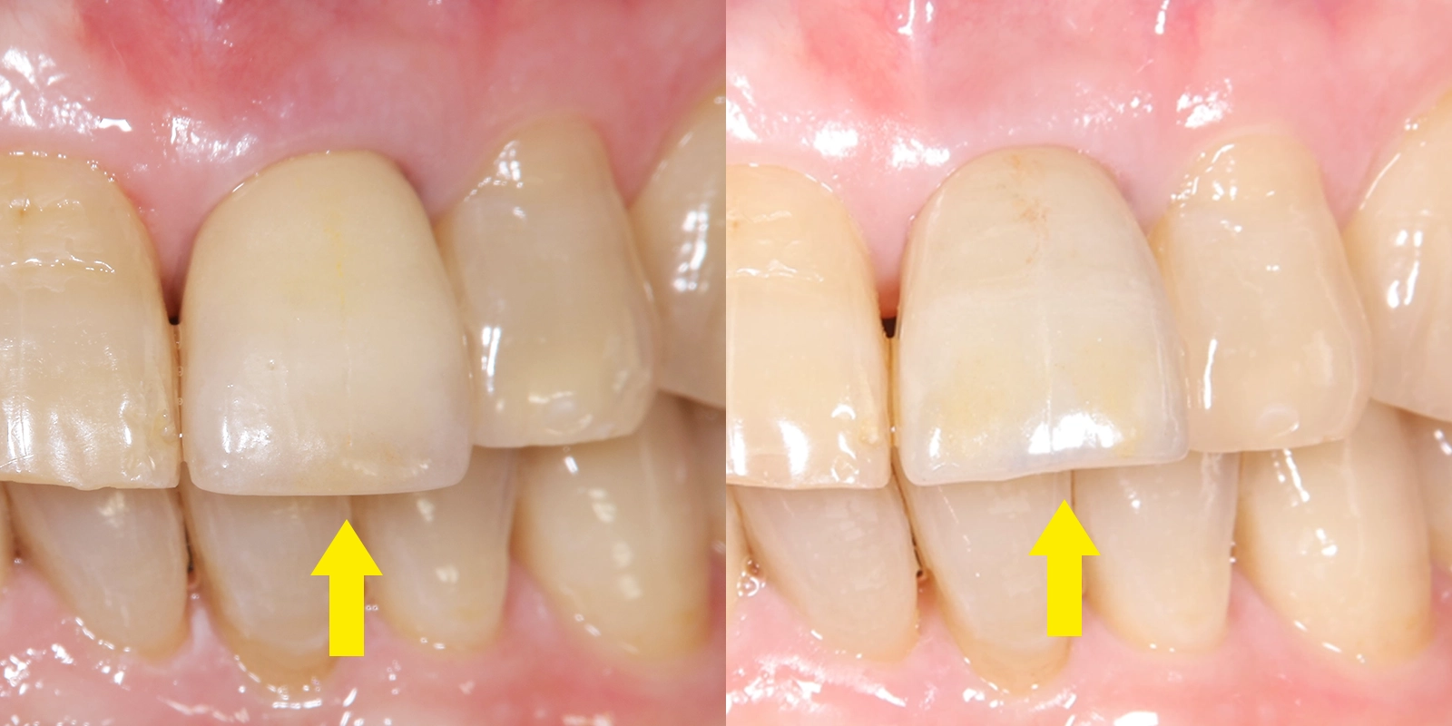 補綴物の軸の調整（光の反射を整える）