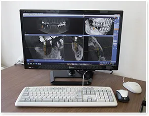 インプラントシミュレーションソフトSIDEXIS