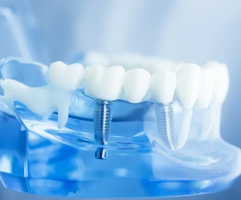 補綴専門医の高度な技術と精密な治療計画による安心のインプラント治療