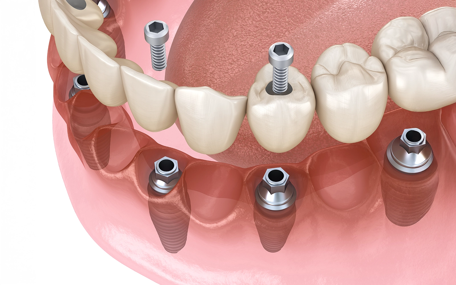 少ない本数で全体を支える仕組み