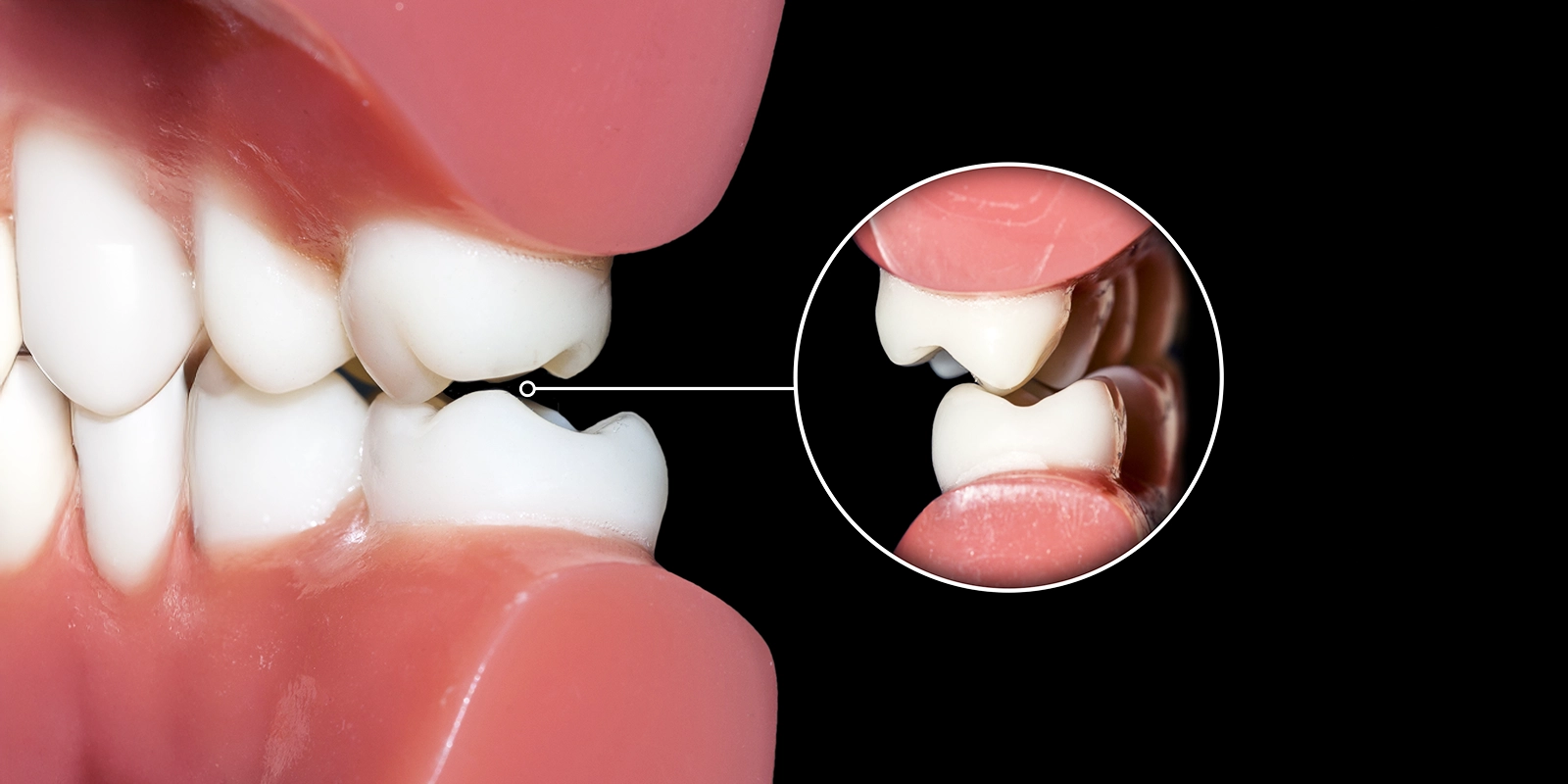 噛み合わせ・顎関節症