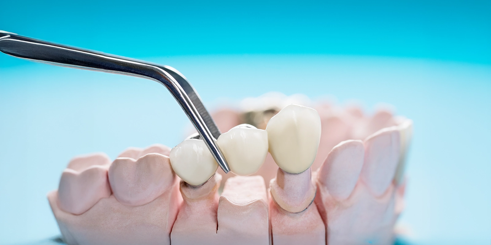 ブリッジとは何か、そして他の治療法との比較