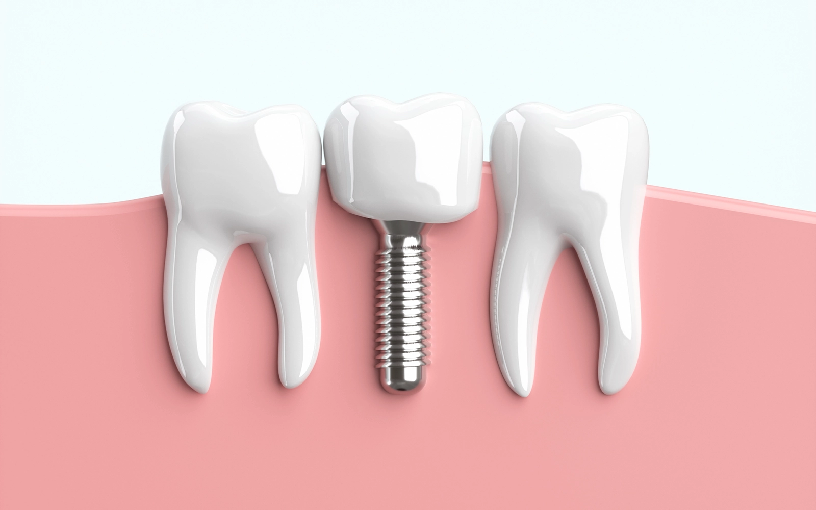 「インプラント」を見る天然歯に近い噛み心地を実現