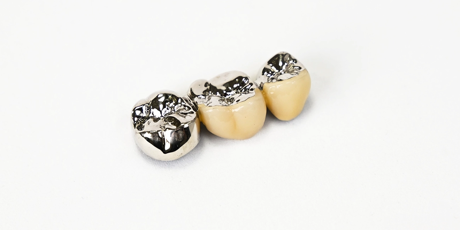 ブリッジの種類と材料の違い