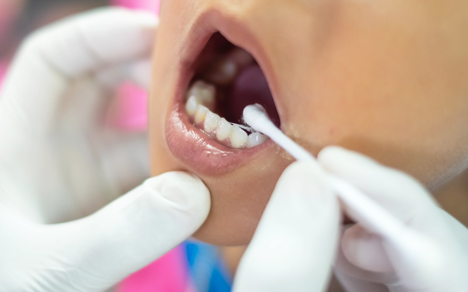 歯質を強化し、虫歯菌の働きを抑制