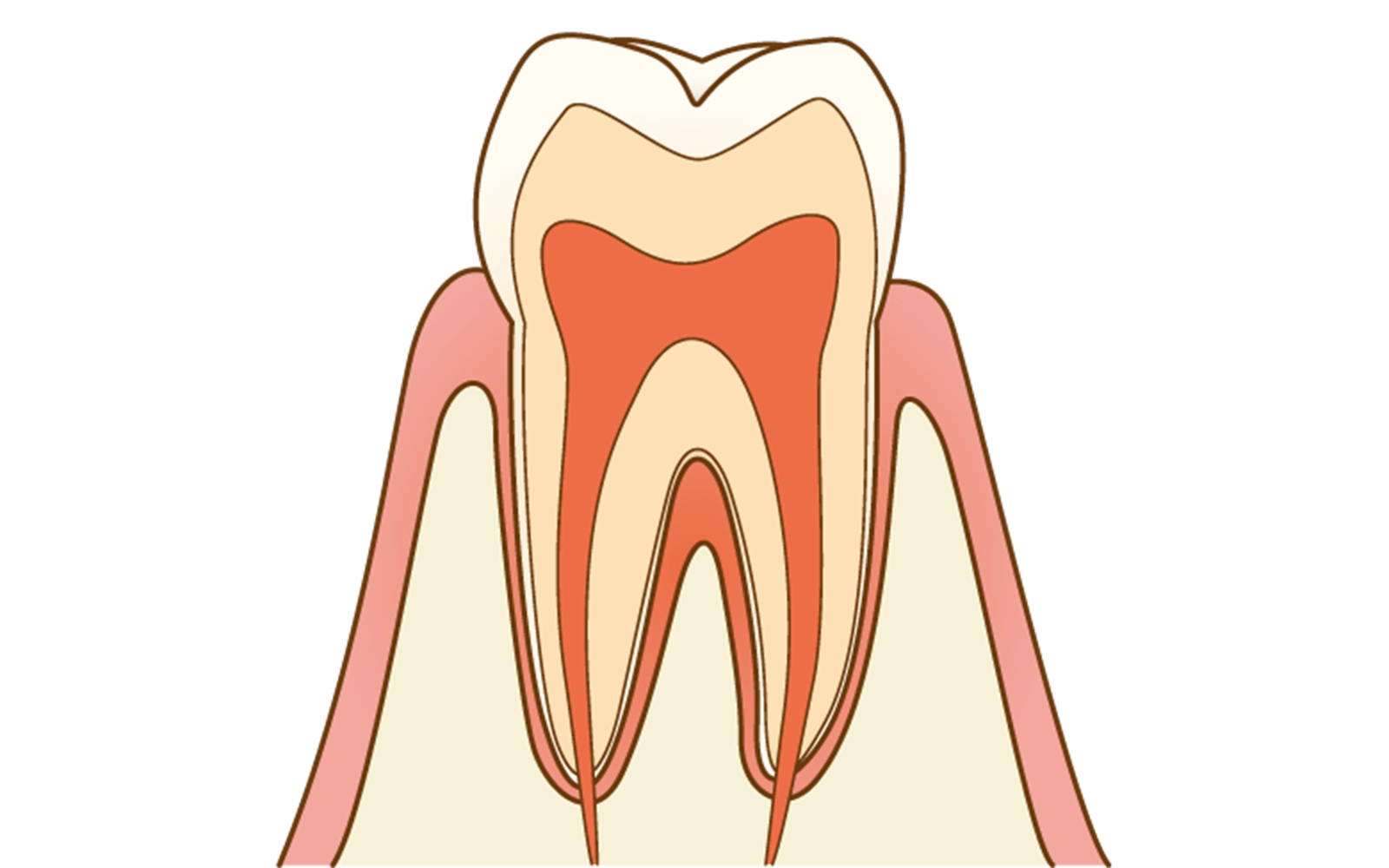C0（初期虫歯）