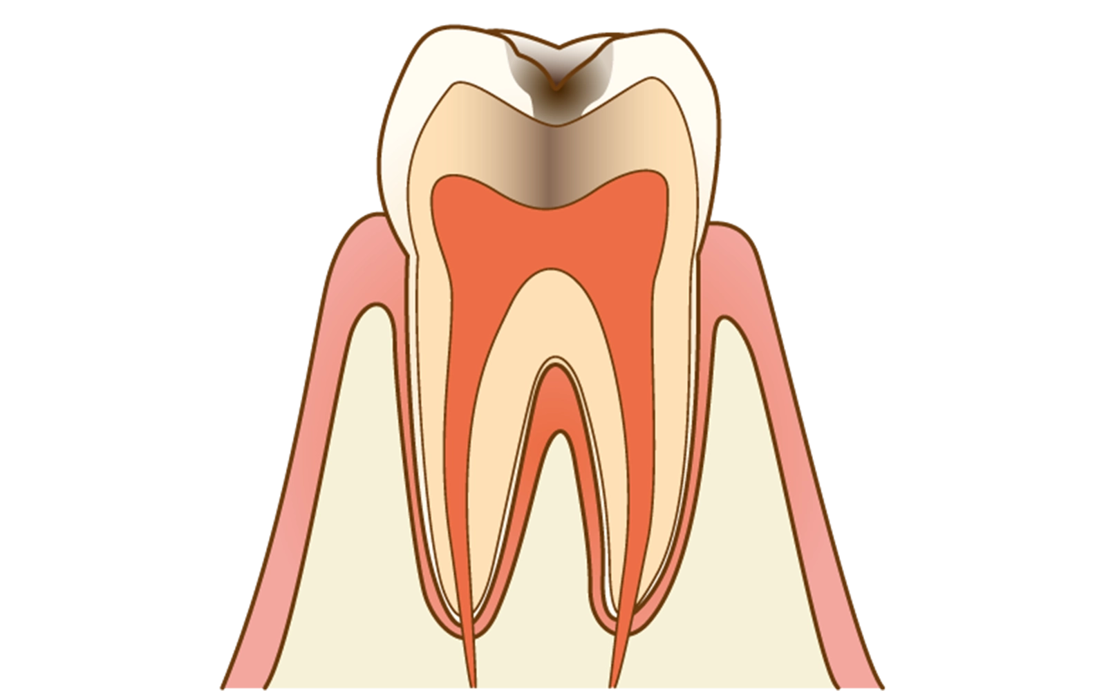 C2（象牙質虫歯）