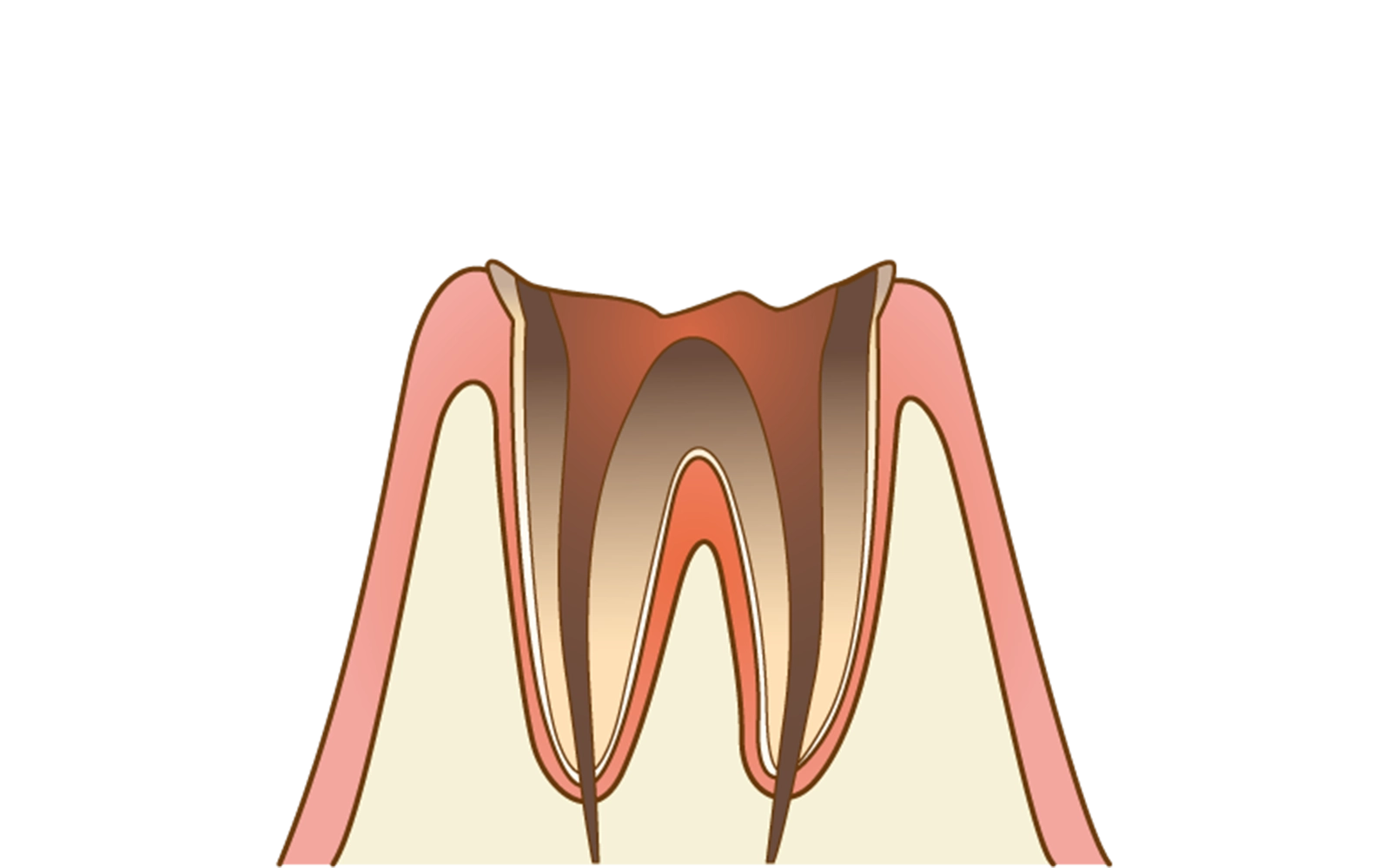 C4（残根状態）
