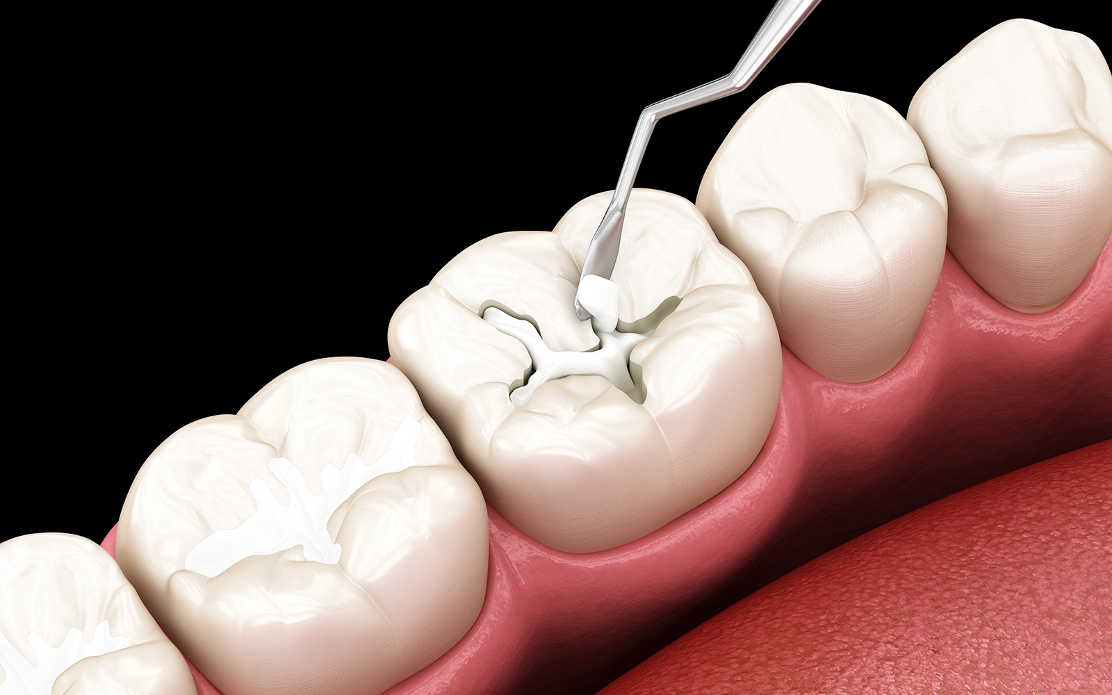 コンポジットレジン充填