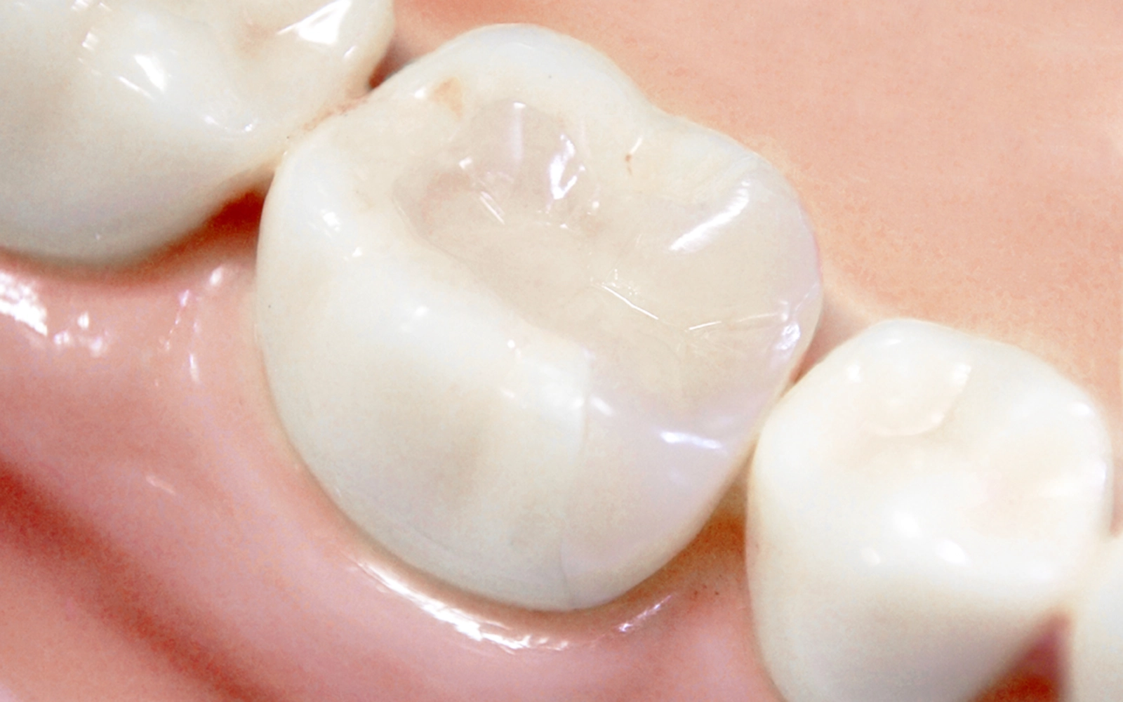 インレー（詰め物）治療