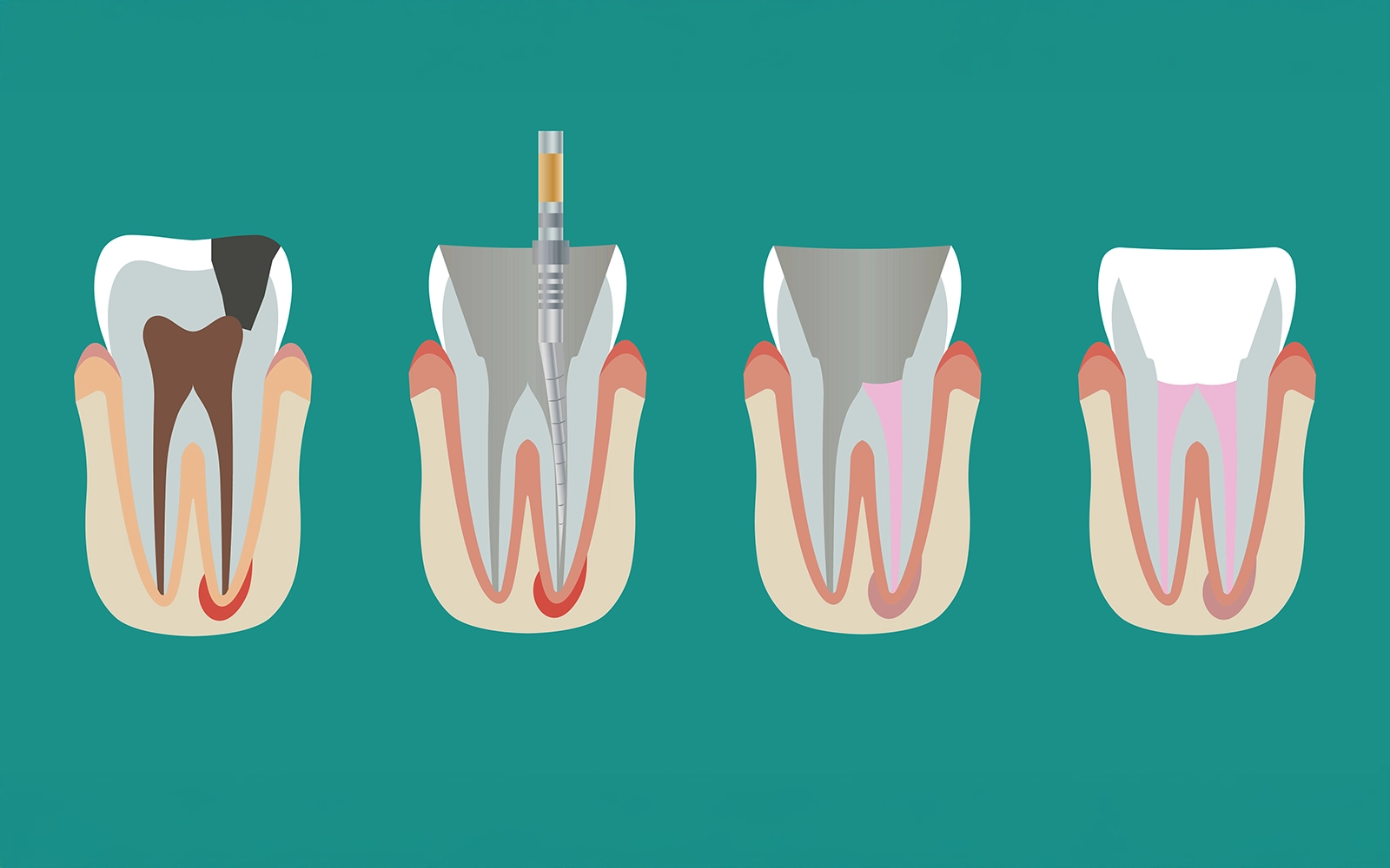 「根管治療」を見る重度の虫歯でも歯を残す治療