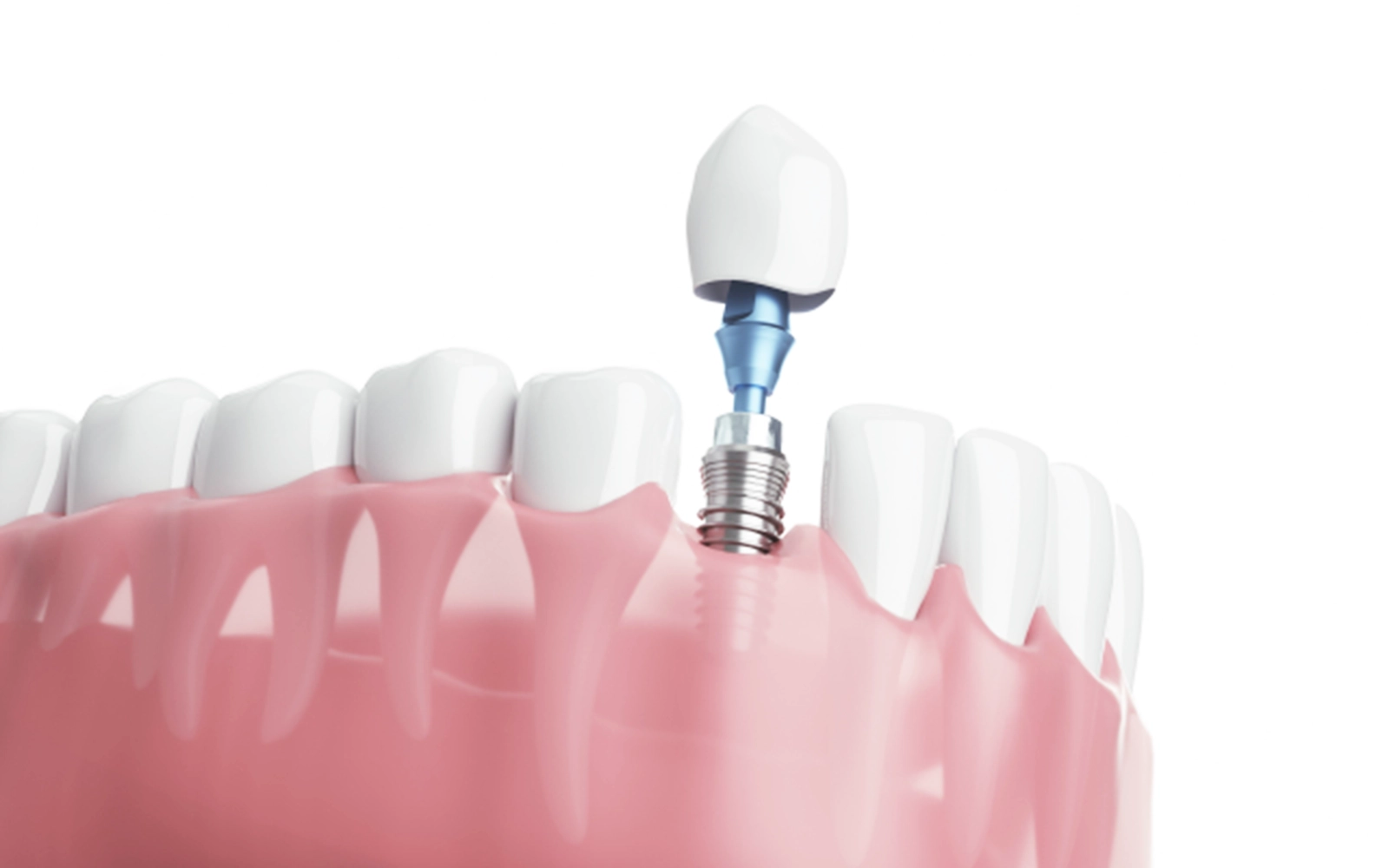「インプラント」を見る天然歯に近い噛み心地を実現