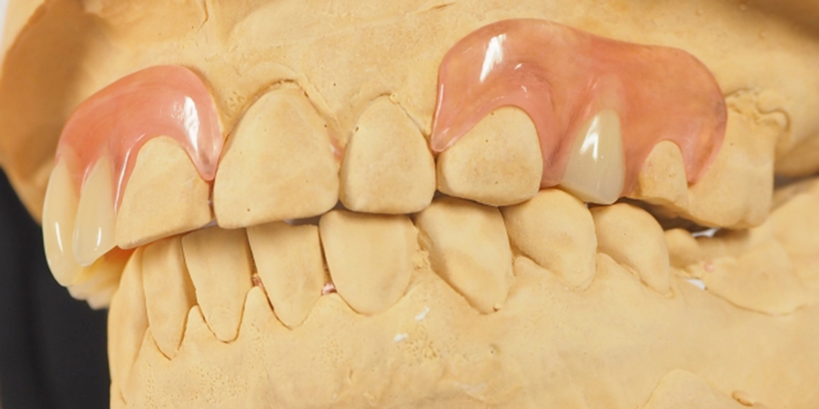 ノンクラスプデンチャー