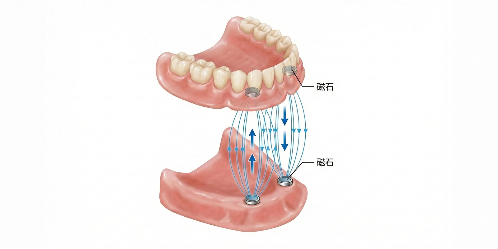磁性アタッチメント義歯