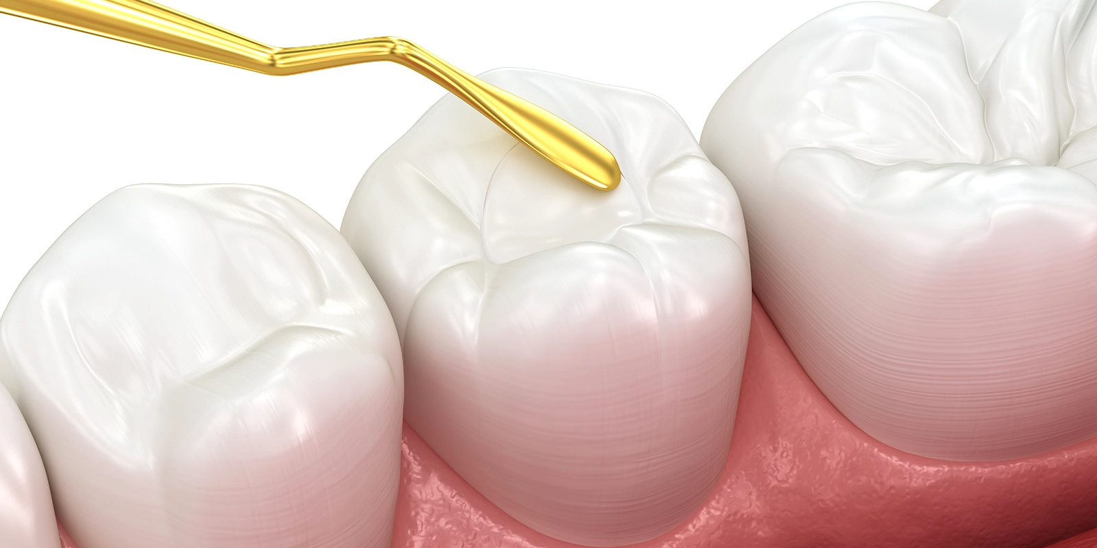 ダイレクトボンディングとは何か