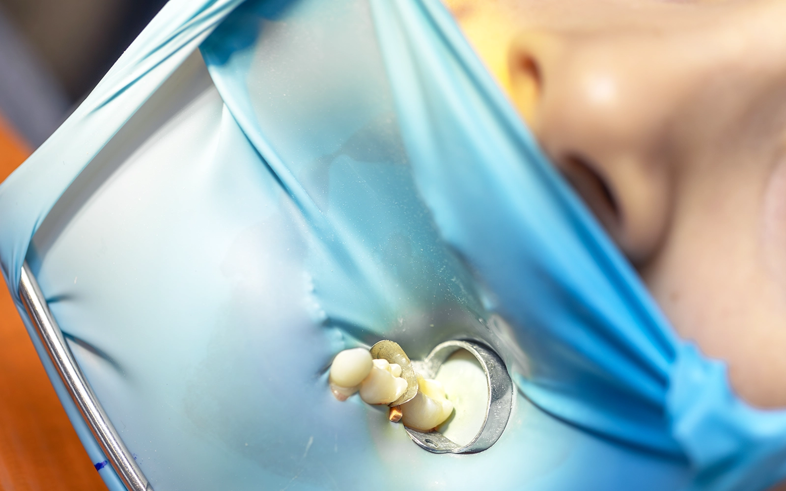 ラバーダム防湿と拡大視野下での高精度な形態再現と接着