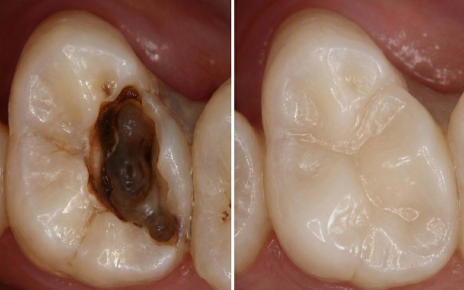 「ダイレクトボンディング」歯を削る量を抑えた修復治療