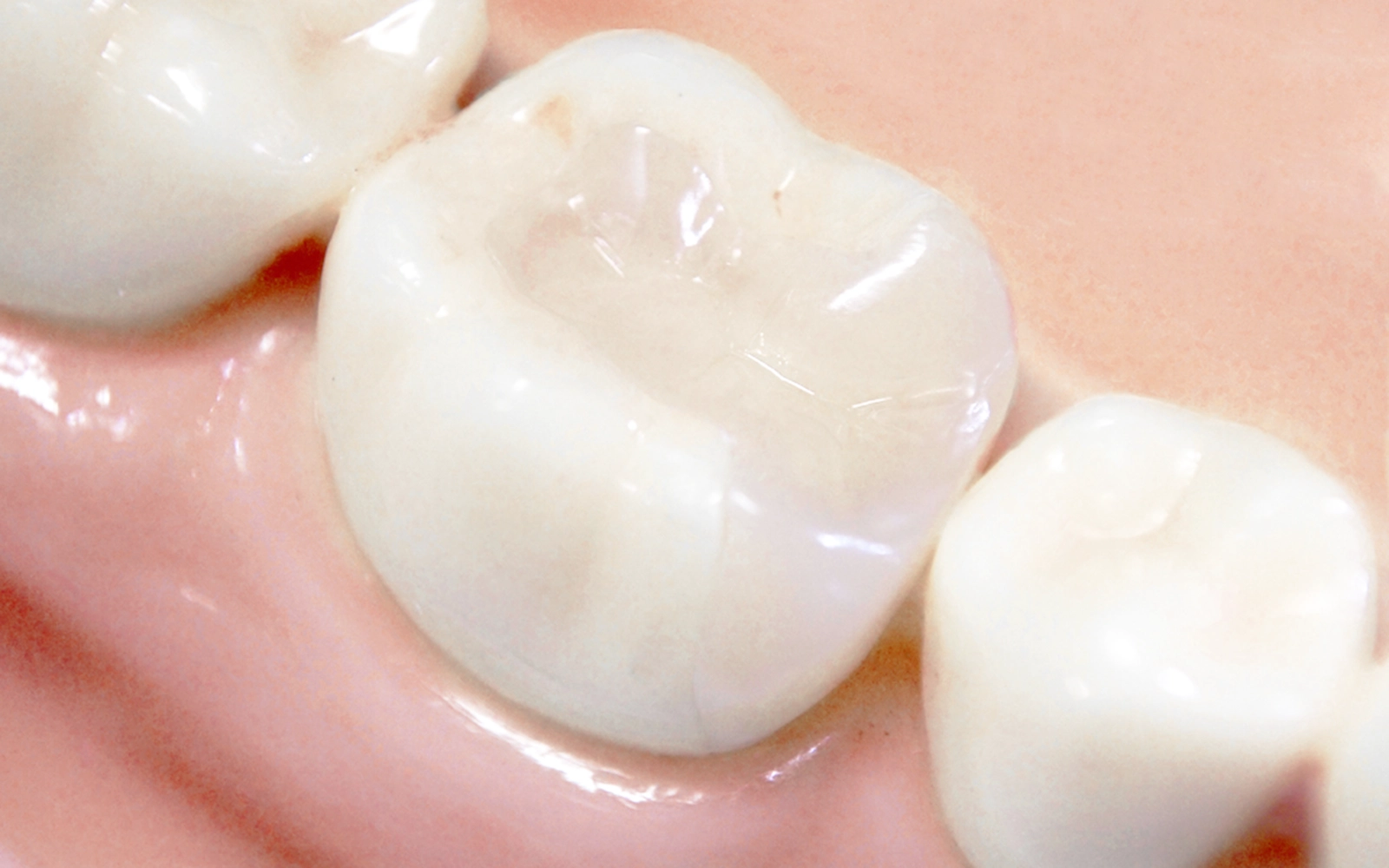 セラミックインレー・アンレー(詰め物)