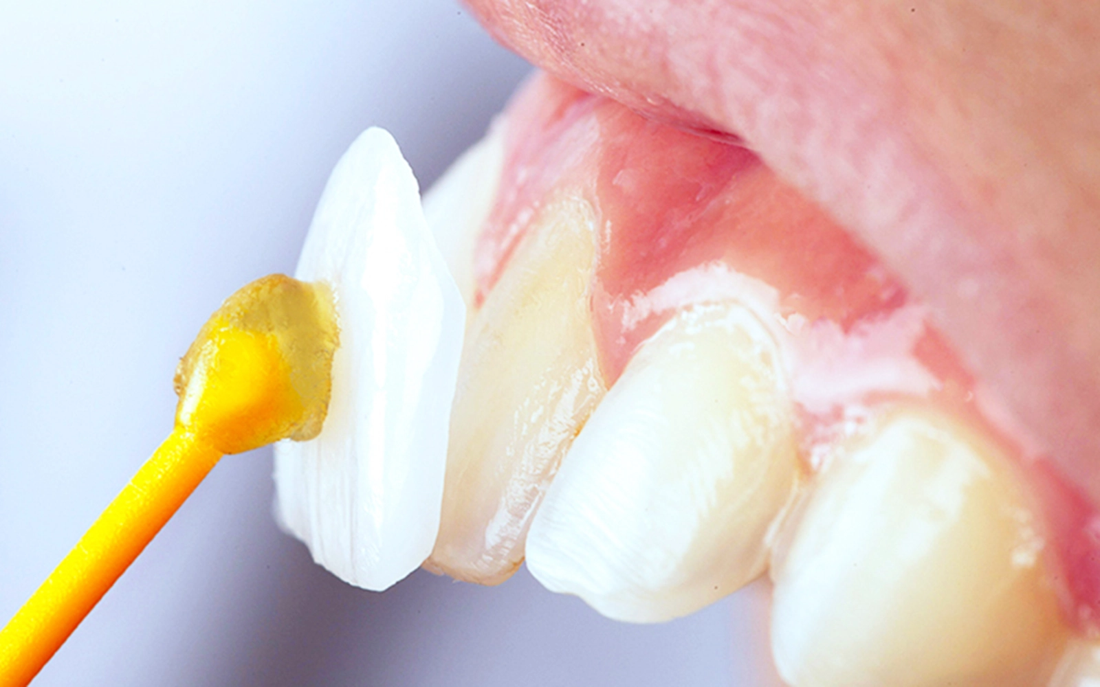 ラミネートベニア