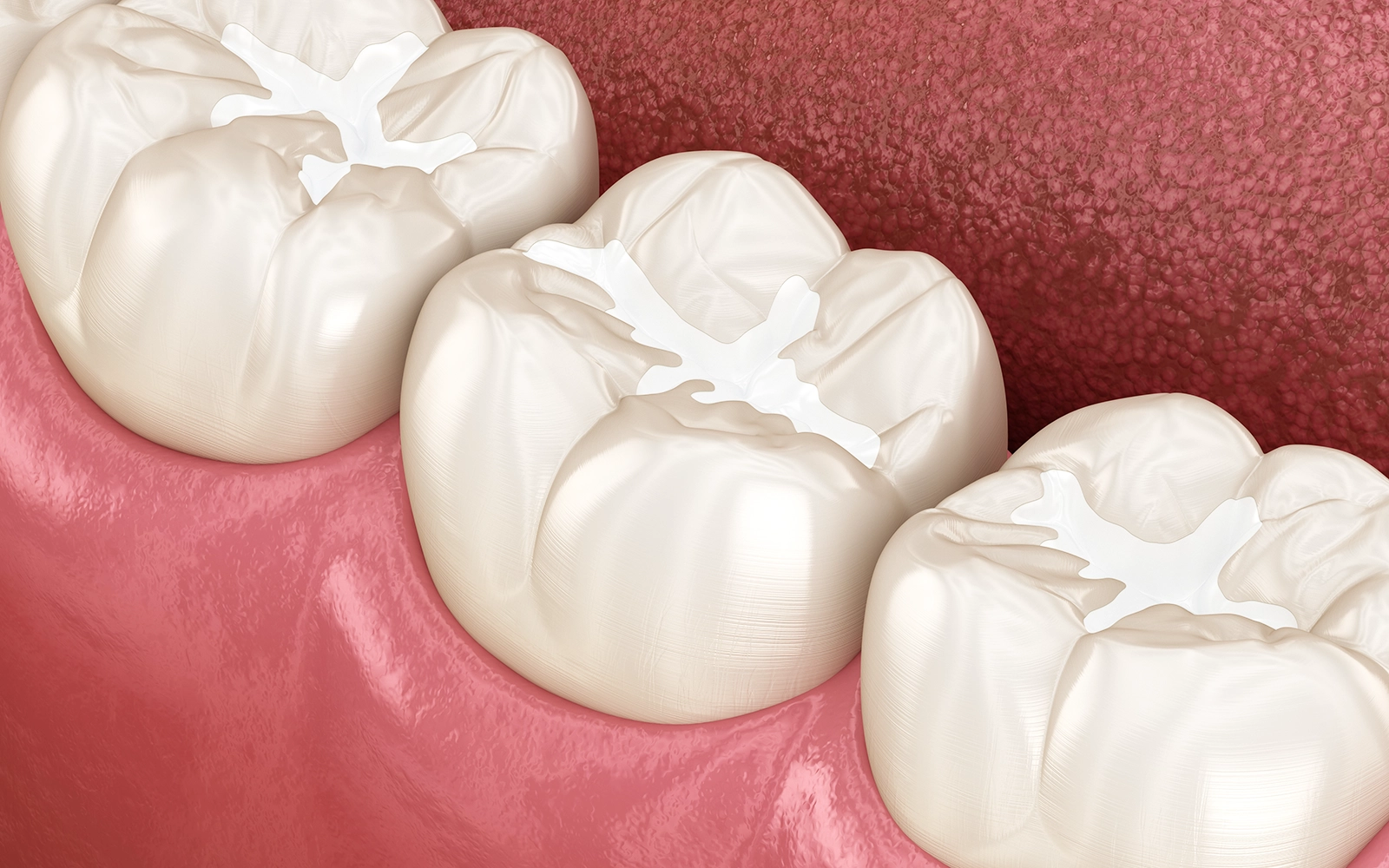 ダイレクトボンディング