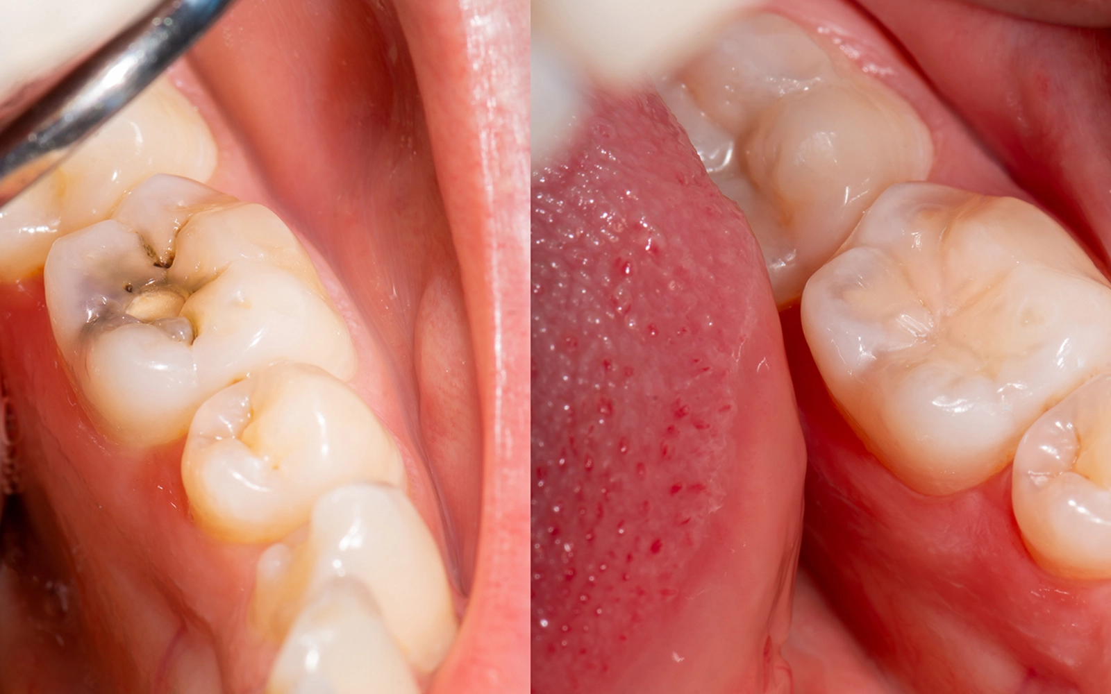 「ダイレクトボンディング」歯を削る量を抑えた修復治療