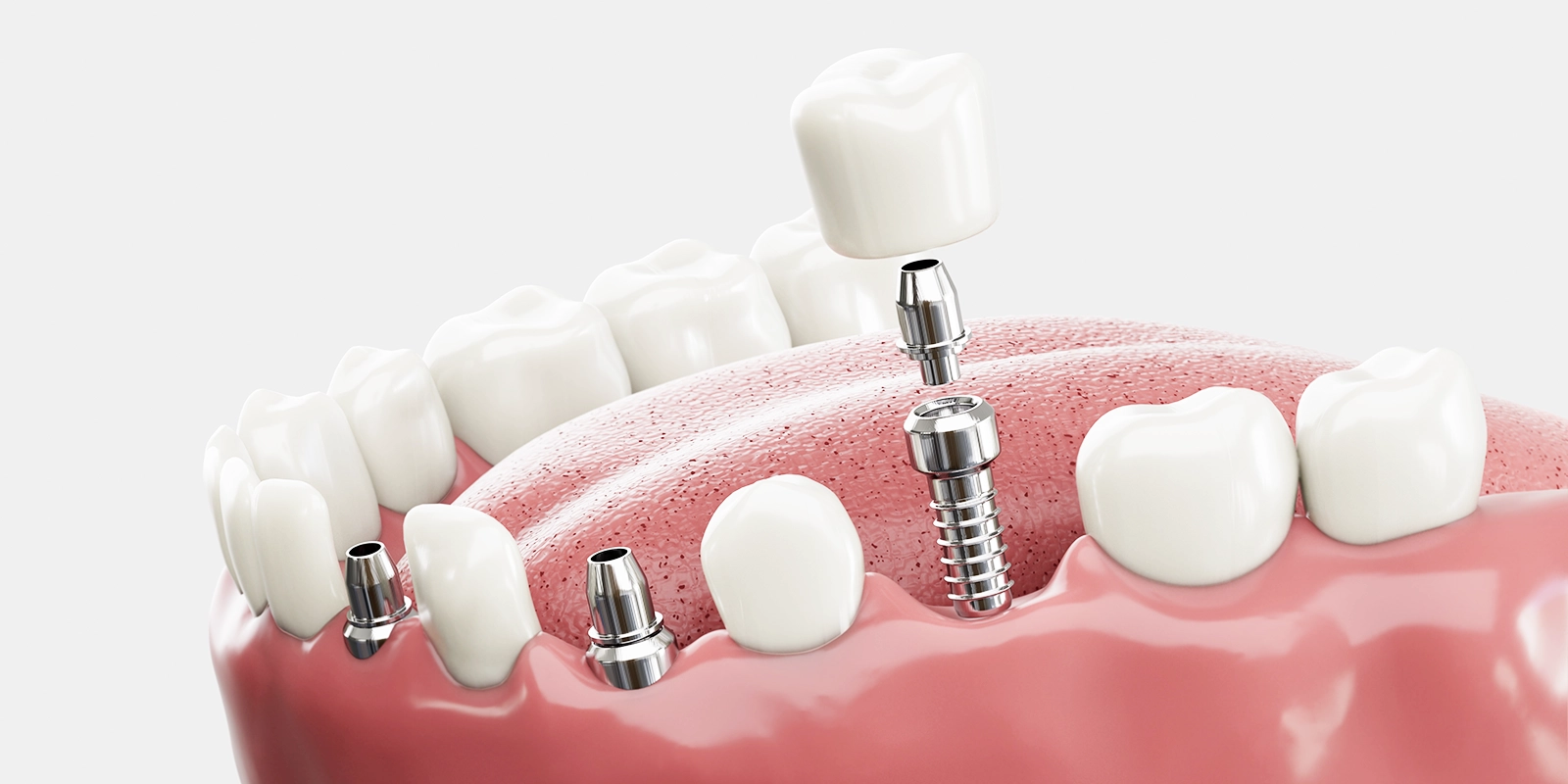 インプラント治療で失った歯の機能を取り戻す仕組み