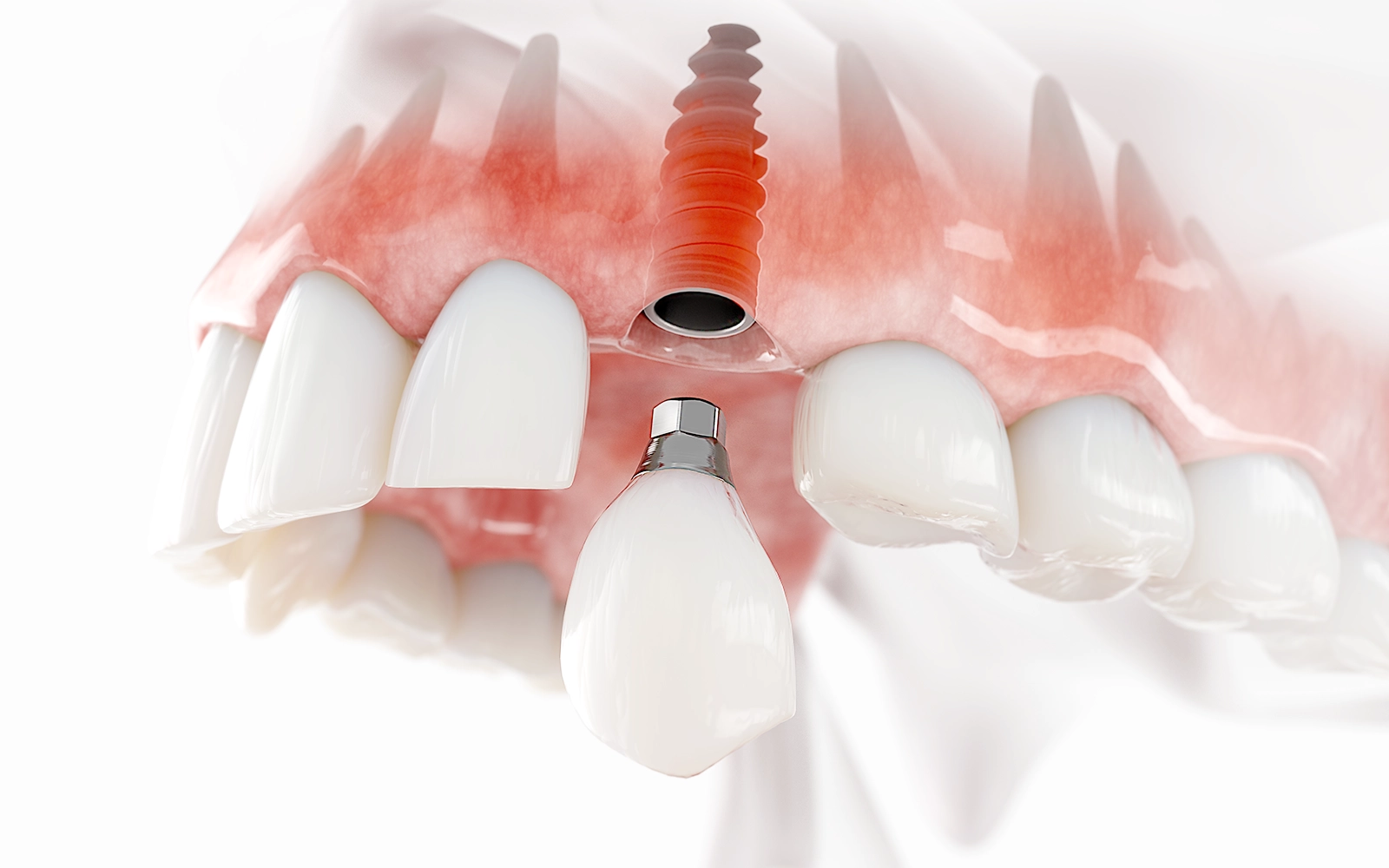 治癒期間と人工歯の装着