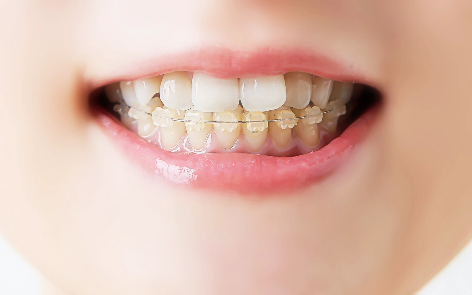 審美ブラケット