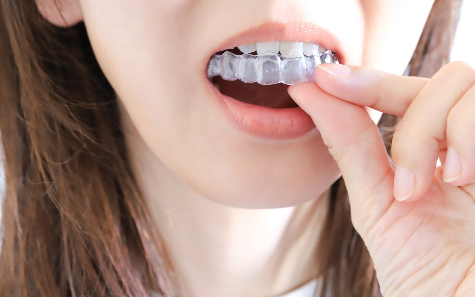 「マウスピース矯正」透明で取り外し可能な矯正治療の説明