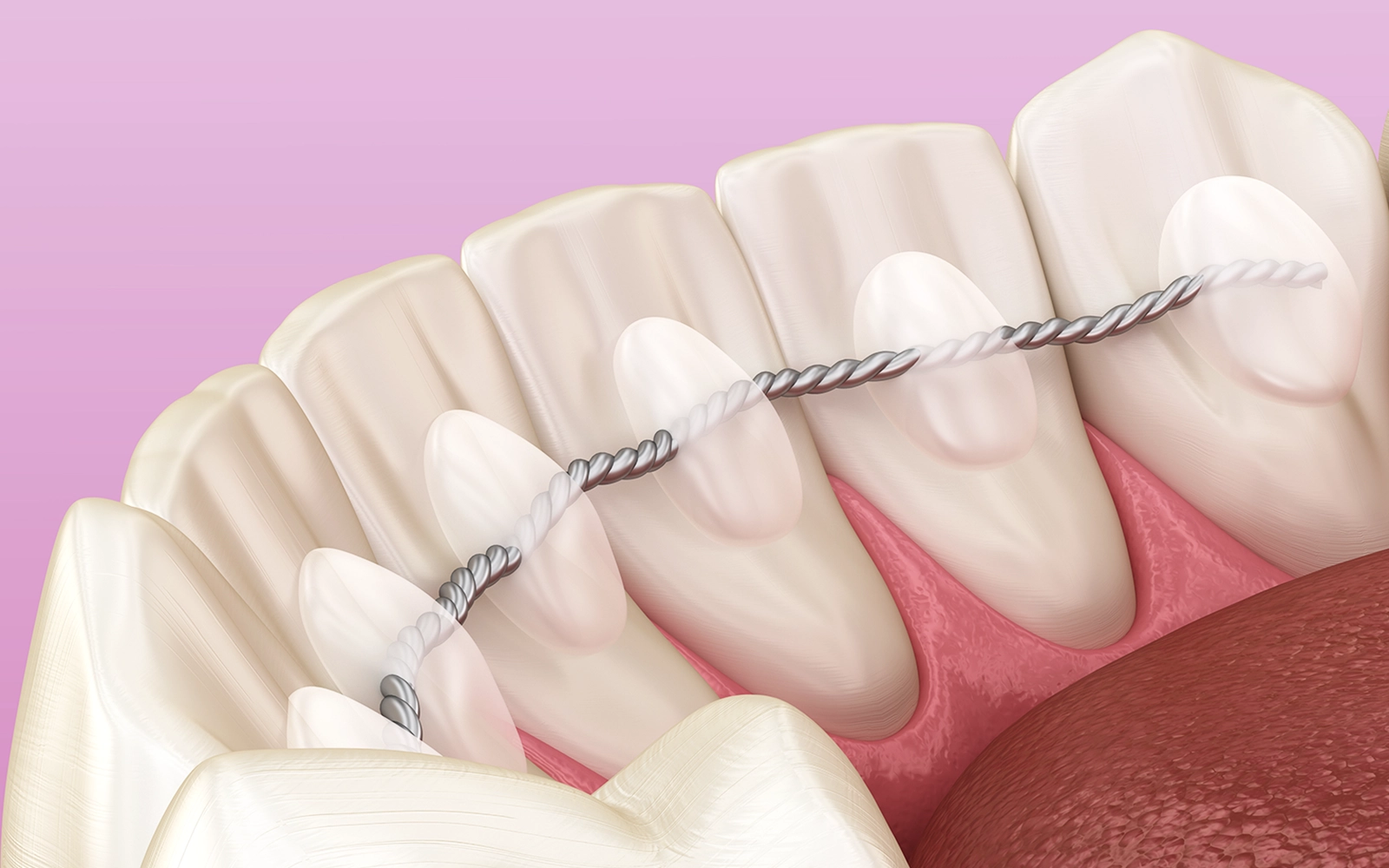 保定期間の重要性とメンテナンス