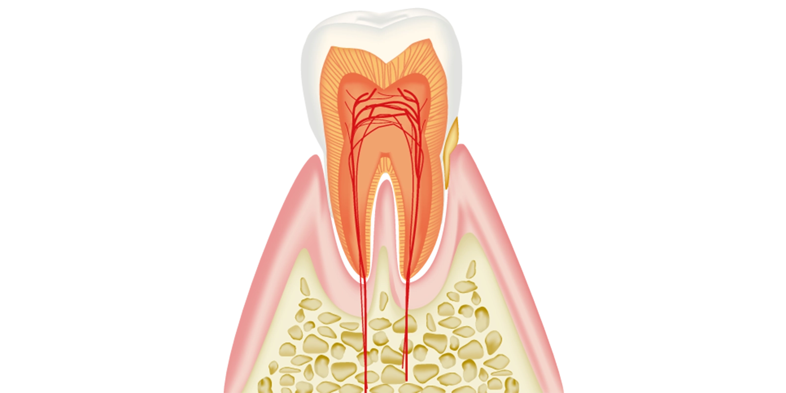 歯肉炎（軽度）