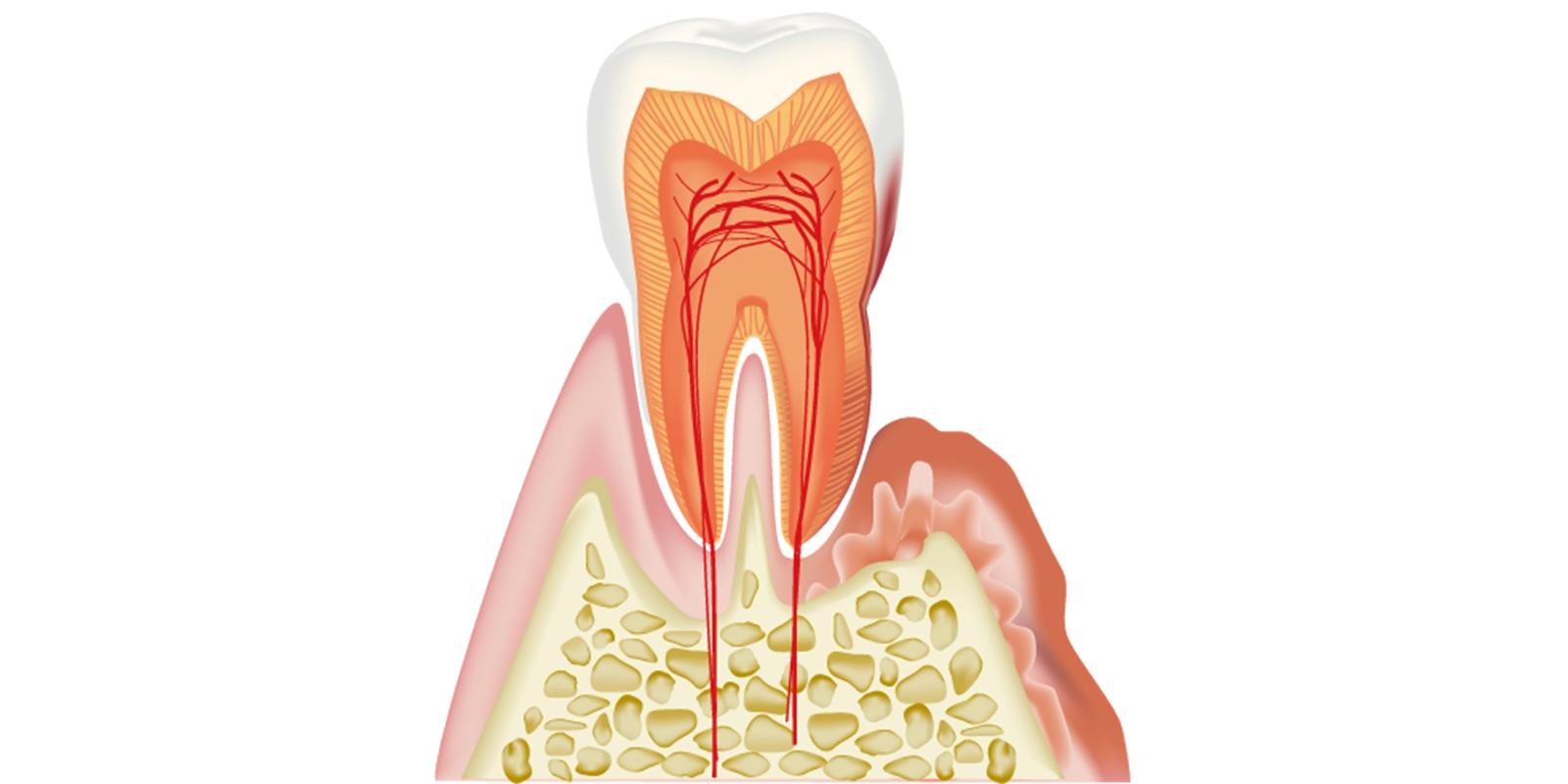 軽度〜中等度歯周炎